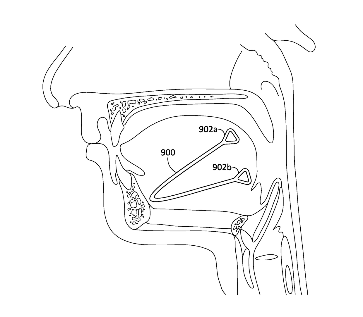 Systems and methods for treatment of sleep apnea