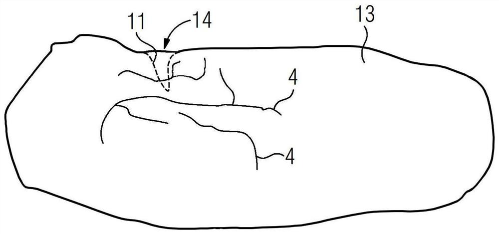 Method and system for supporting medical personnel during a resection, and computer program product