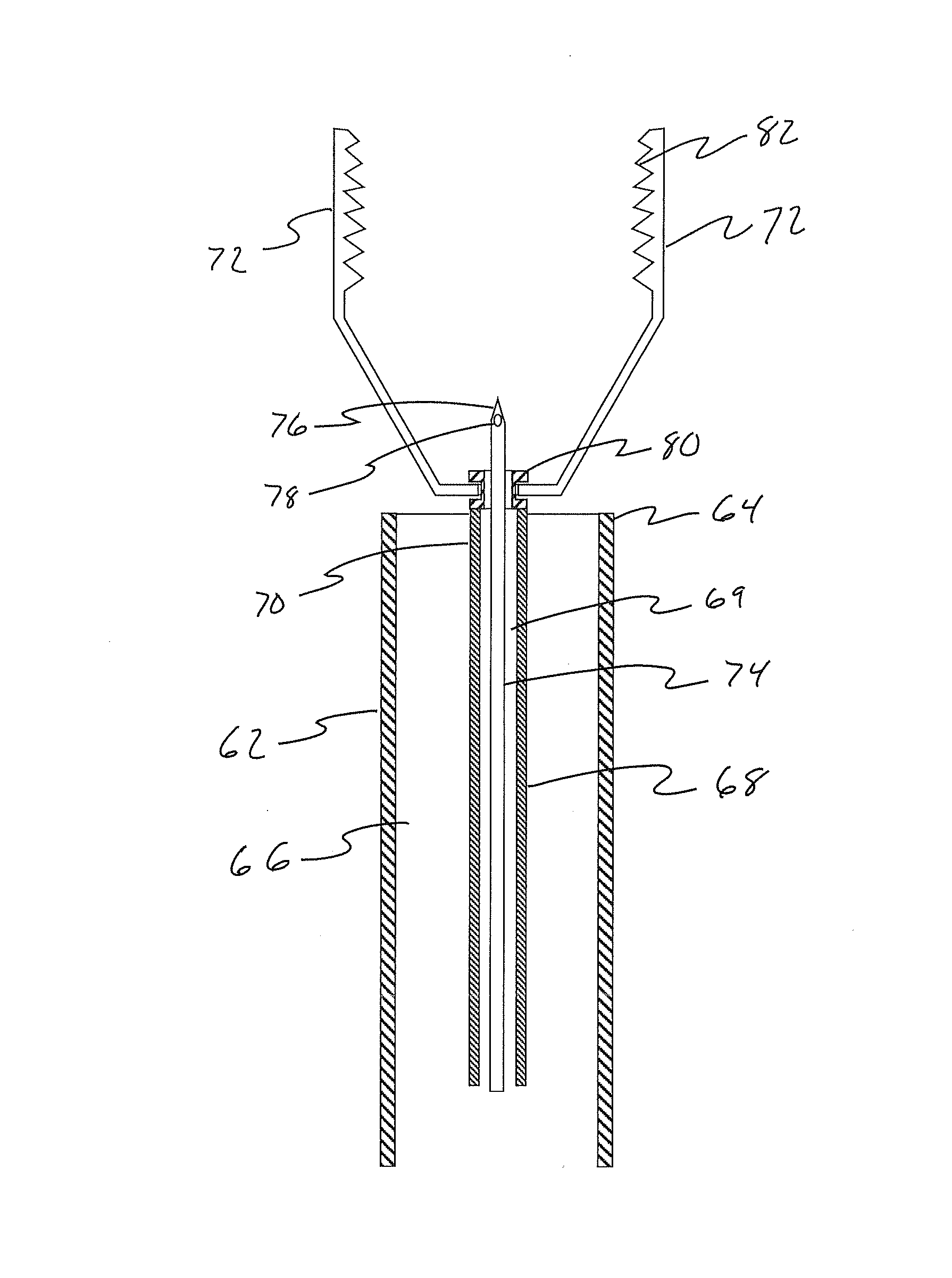 Methods and Systems for Submucosal Implantation of a Device for Diagnosis and Treatment of a Body