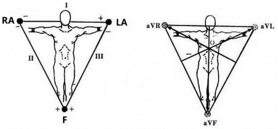 A Correction Method for Electrocardiogram Lead Misconnection