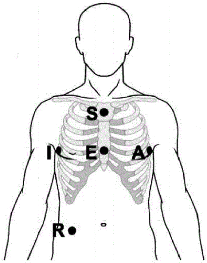 A Correction Method for Electrocardiogram Lead Misconnection