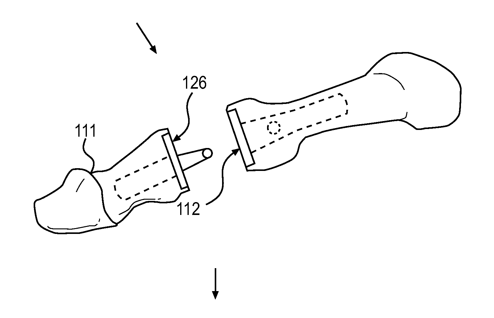 Interphalangeal Joint Implant Methods and Apparatus