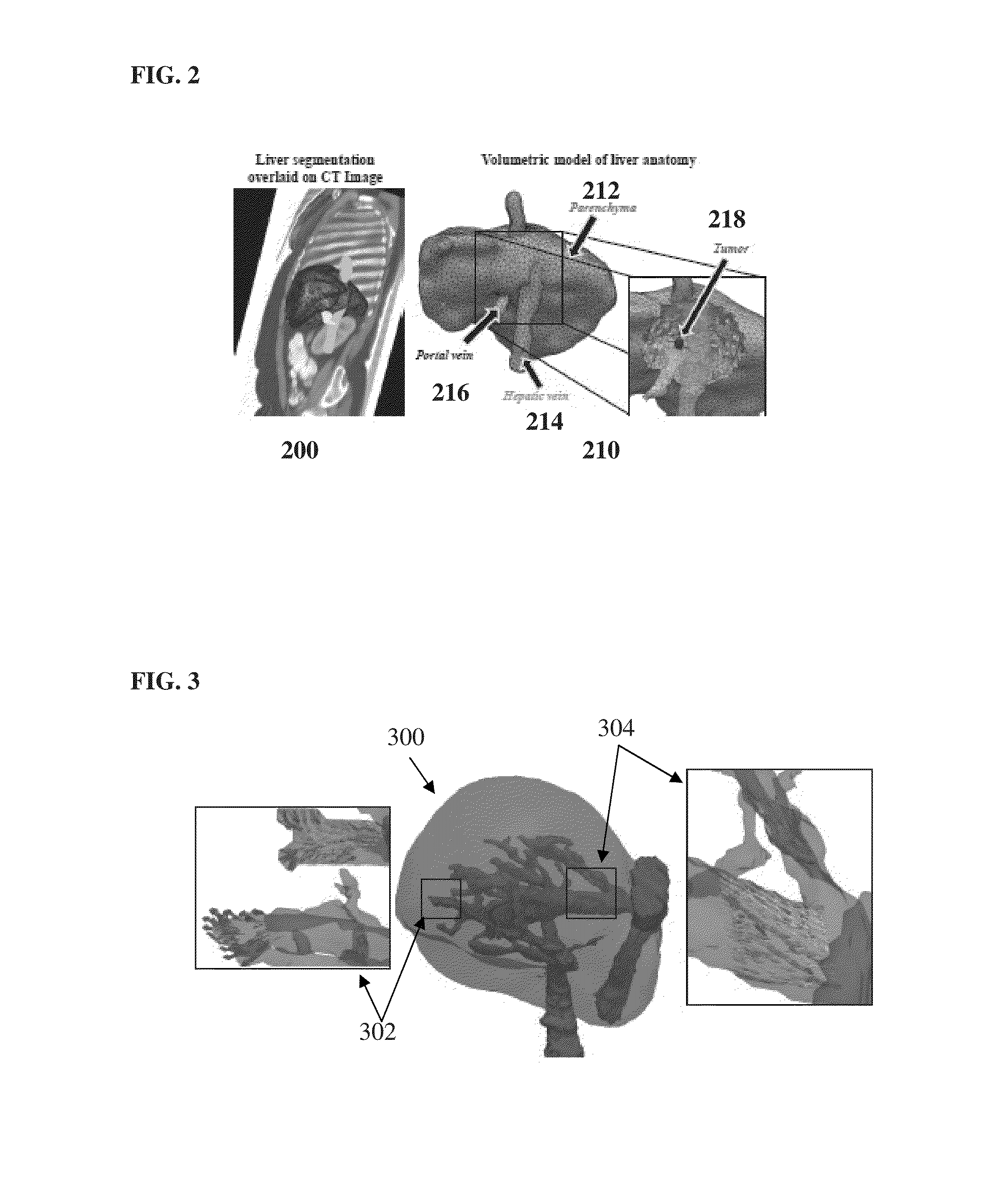 System and Method for Personalized Computation of Tissue Ablation Extent Based on Medical Images