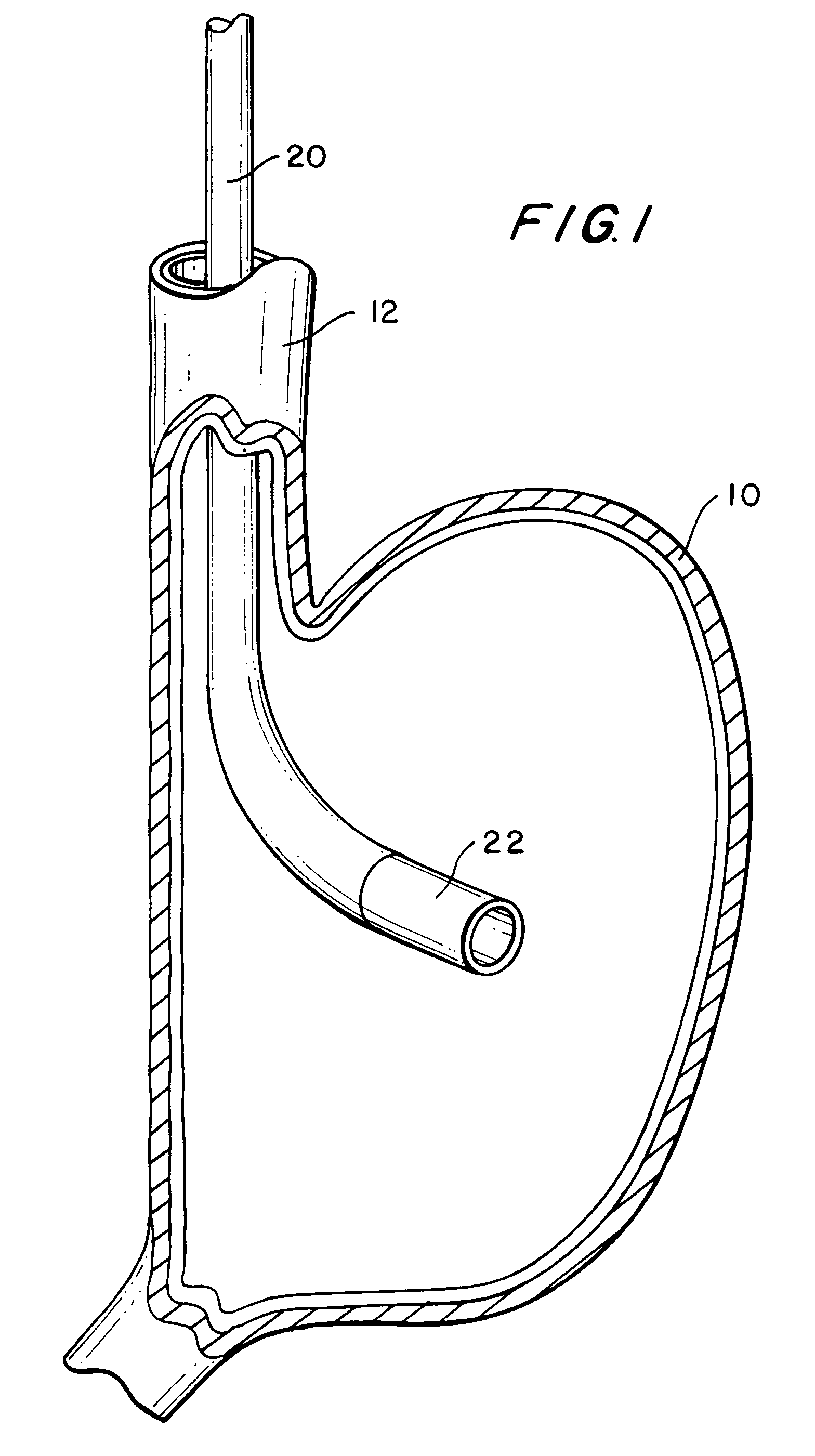 Stomach reduction methods and apparatus