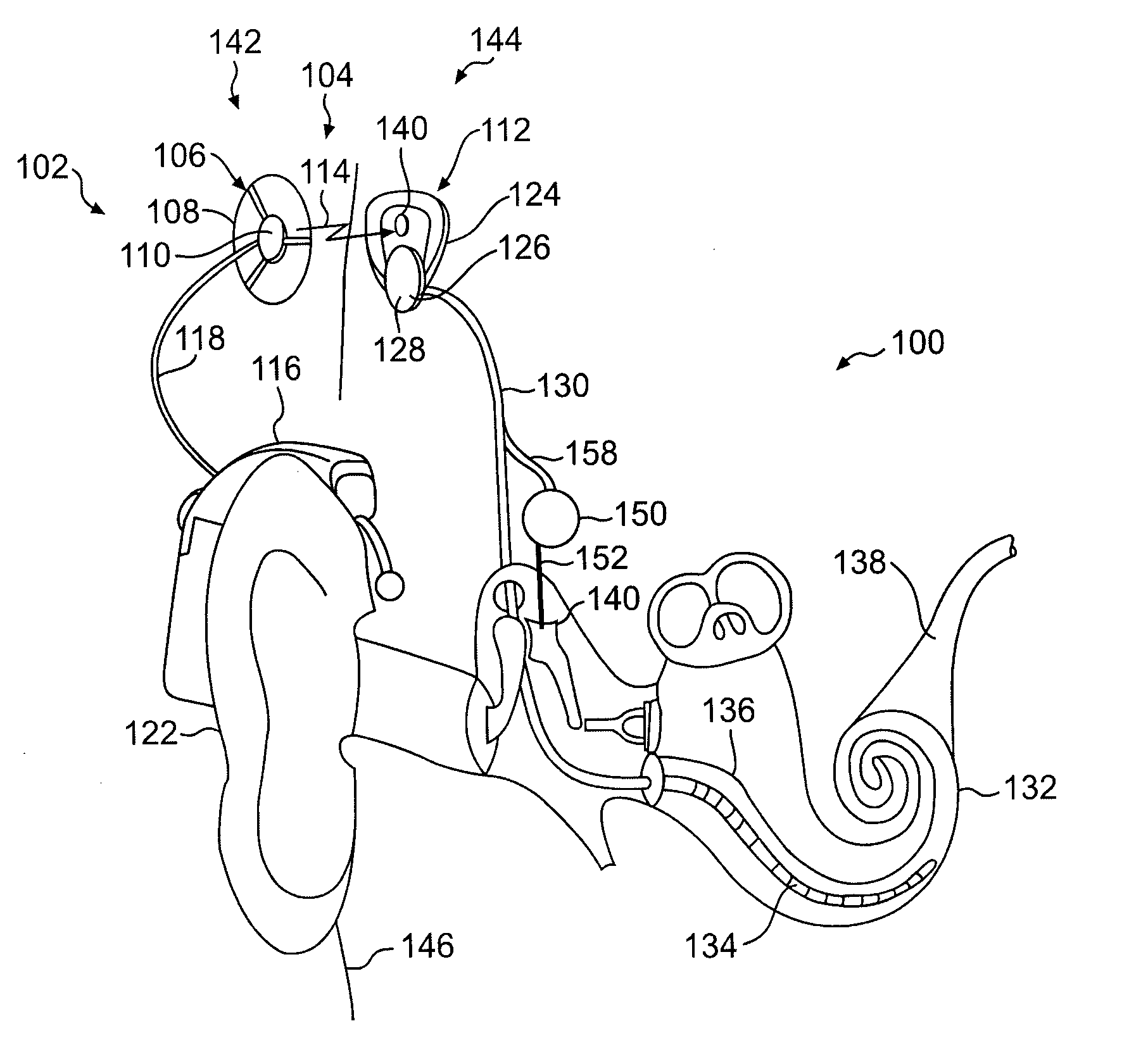 Using a genetic algorithm to fit a cochlear implant system to a patient