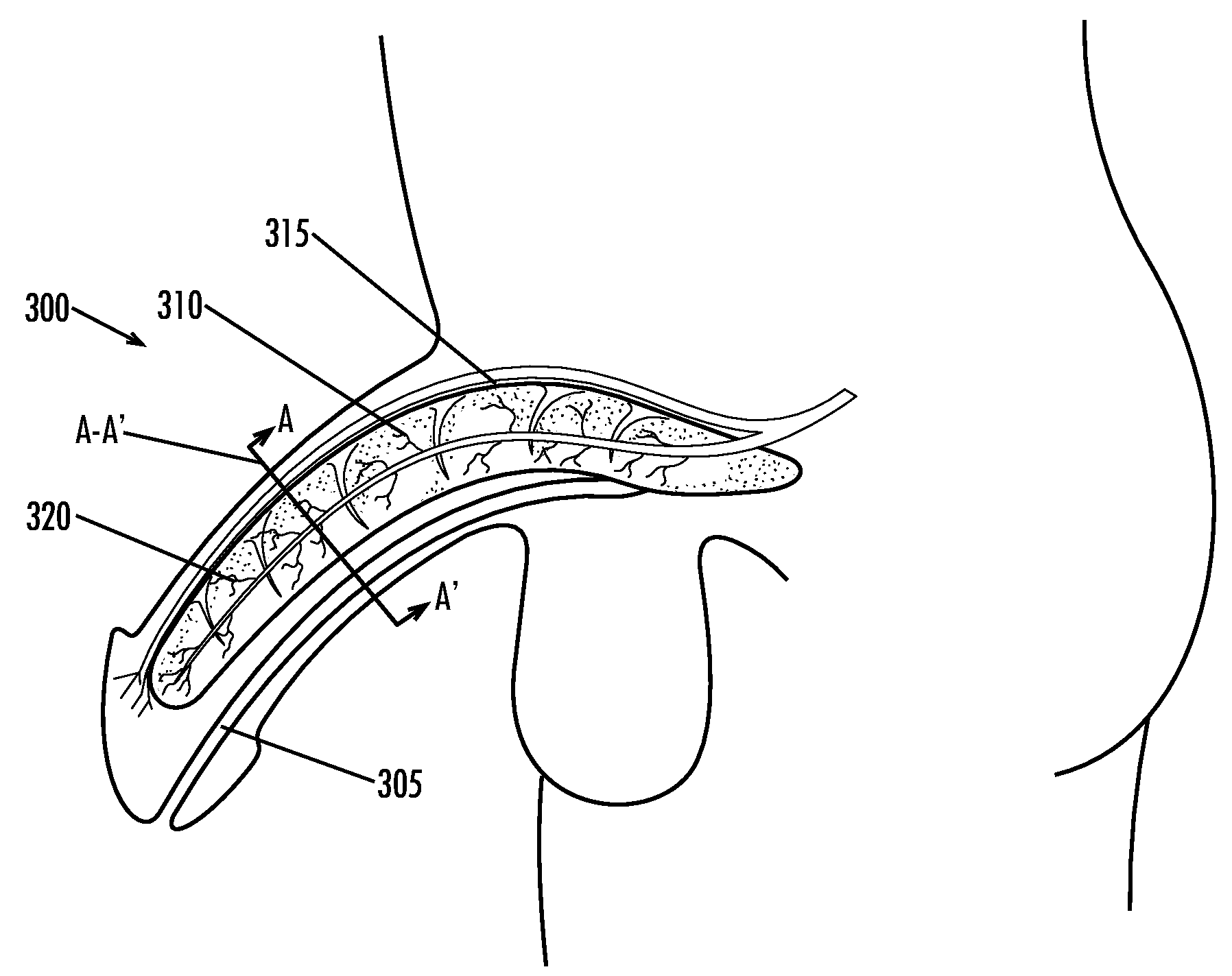 Loadable Polymeric Particles for Therapeutic Use in Erectile Dysfunction and Methods of Preparing and Using the Same