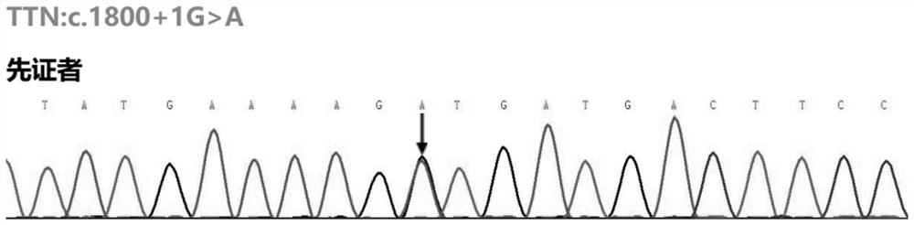 TTN mutant gene and dilated cardiomyopathy detection kit