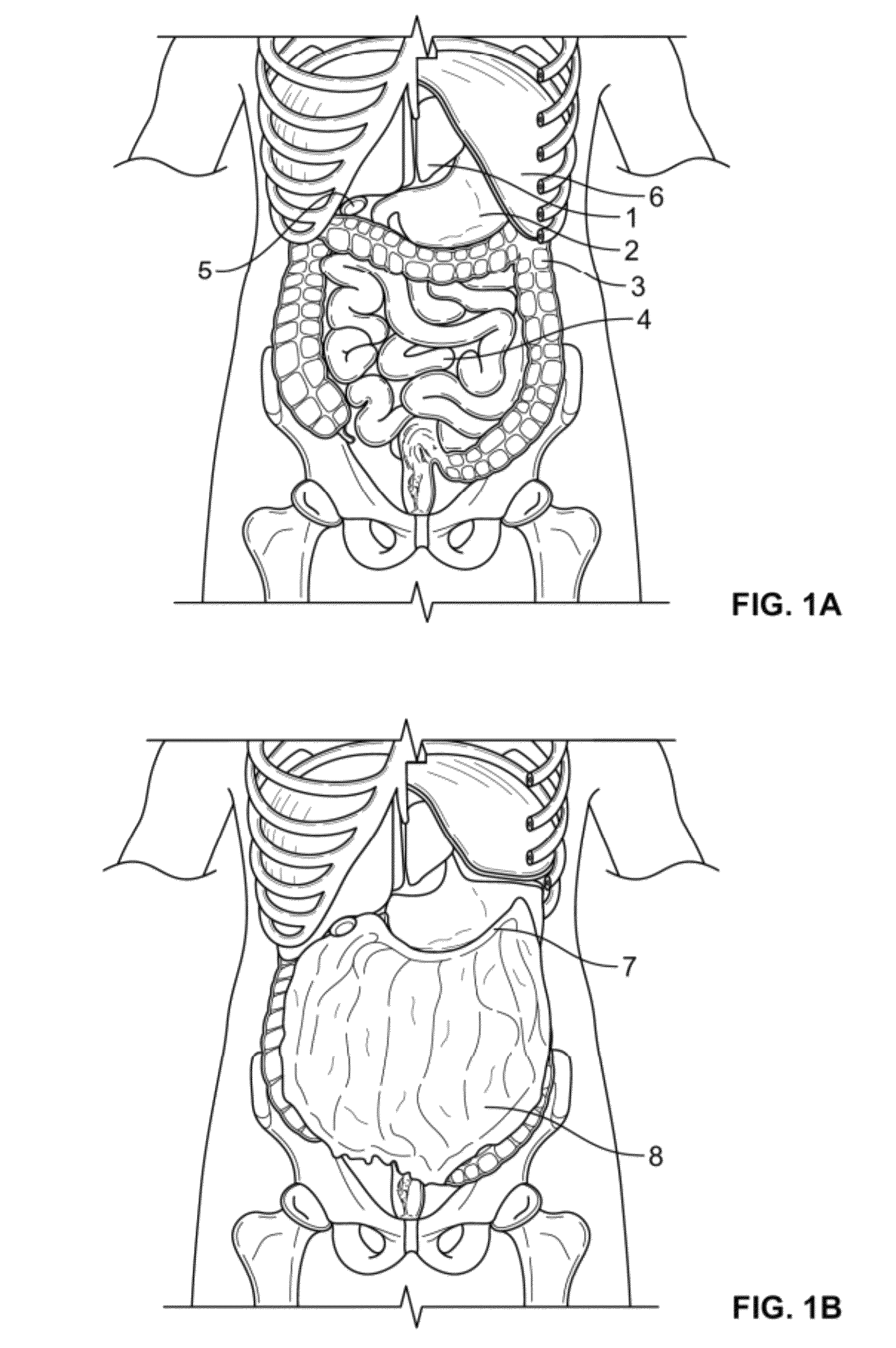 Methods and devices for removing omental tissue