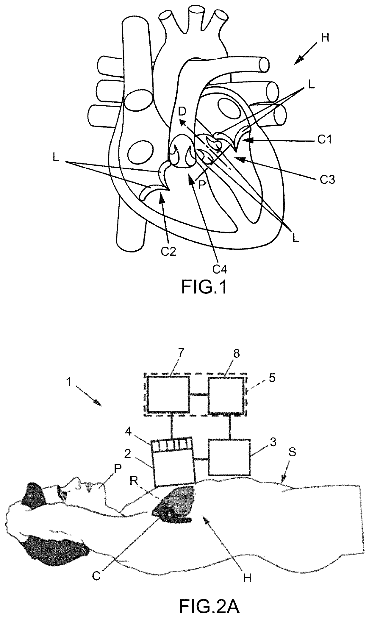 Method and apparatus for treating valvular disease