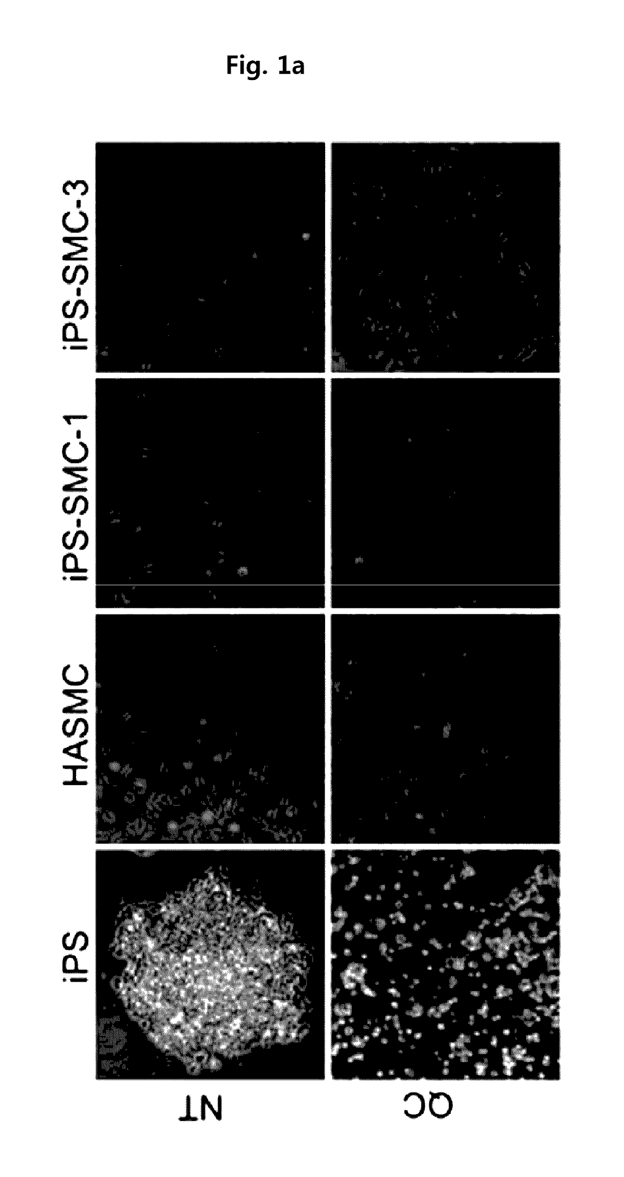 Method for suppressing teratoma formation via selective cell death induction in undifferentiated human-induced pluripotent stem cells