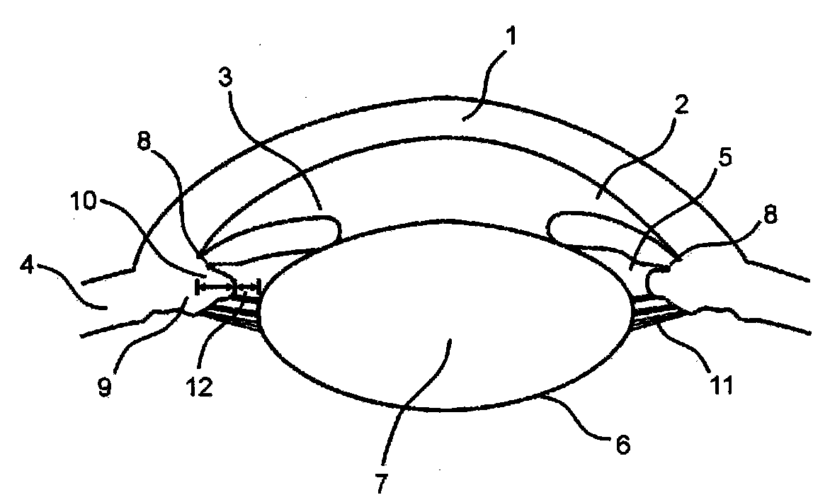 Adjustable accommodating intraocular lens and positioning means