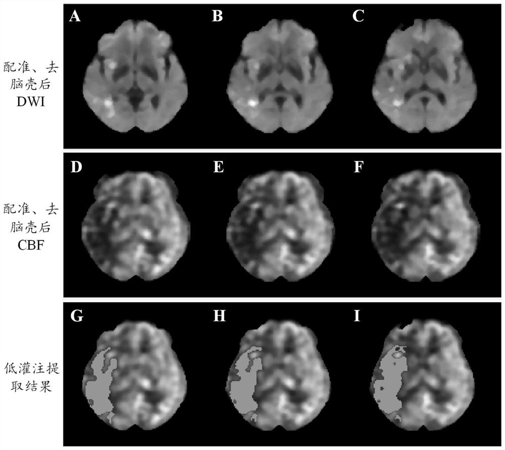 Arterial spin labeling-based cerebral hypoperfusion region accurate quantification method