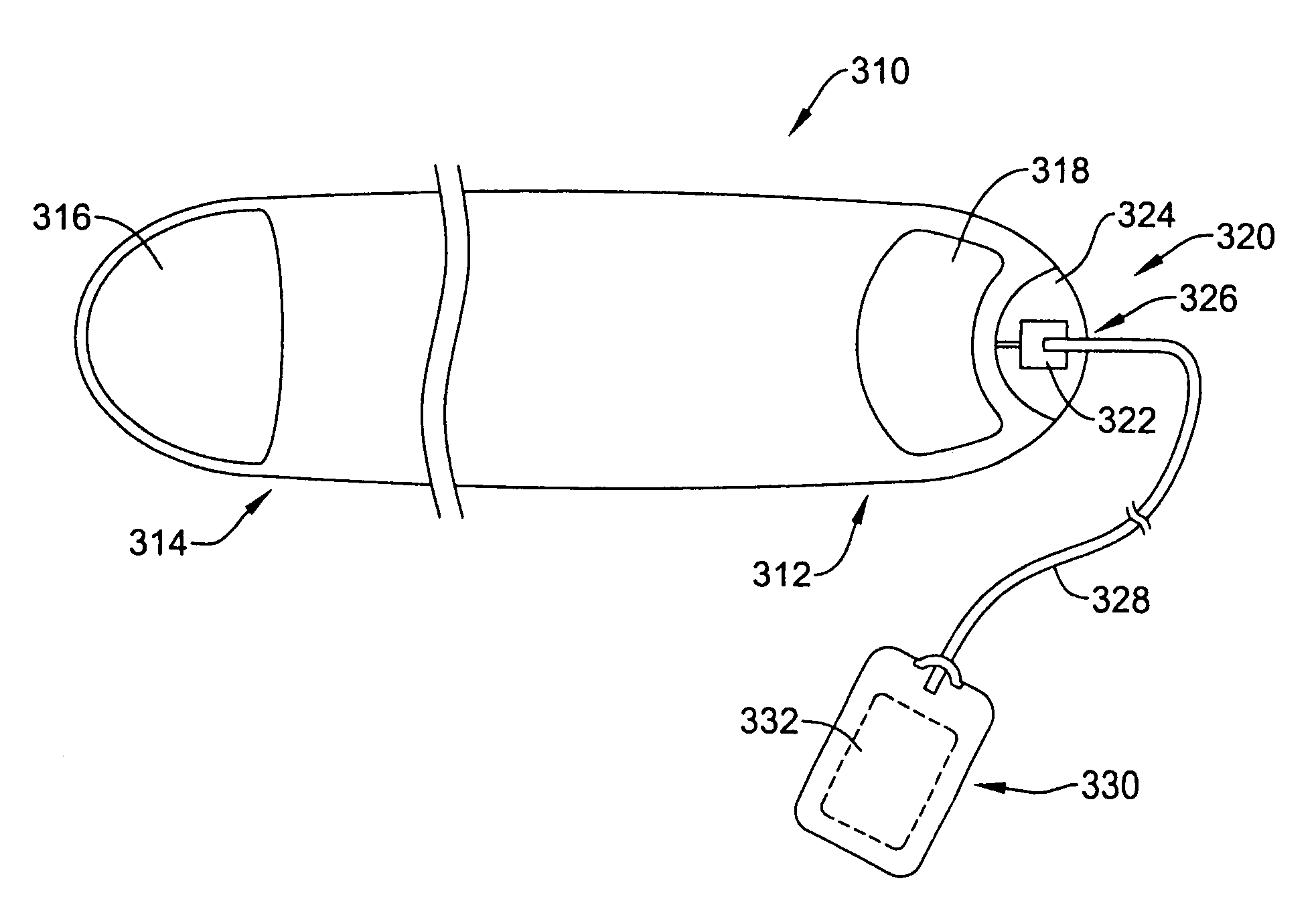 Implantable cardioverter-defibrillator having two spaced apart shocking electrodes on housing