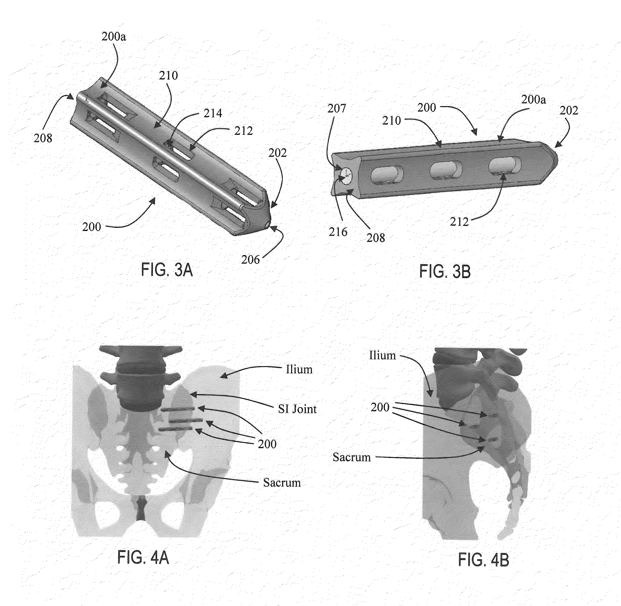 Apparatus and methods for immobilization and fusion of a synovial joint