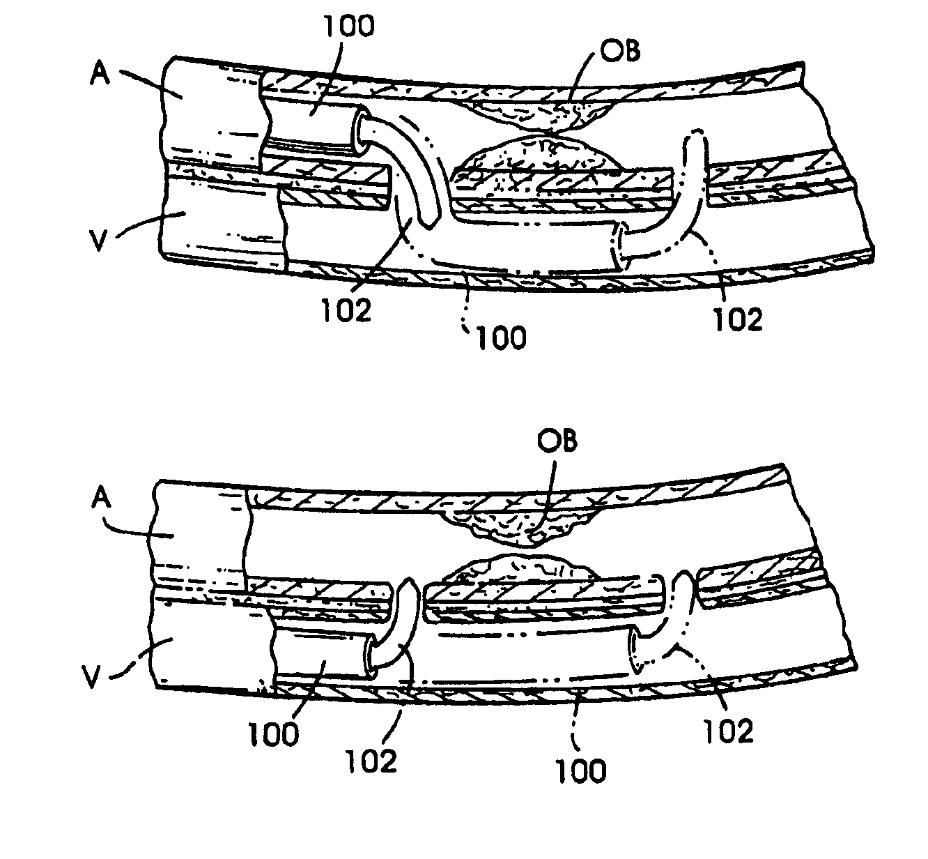 Methods and apparatus for bypassing arterial obstructions and/or performing other transvascular procedures