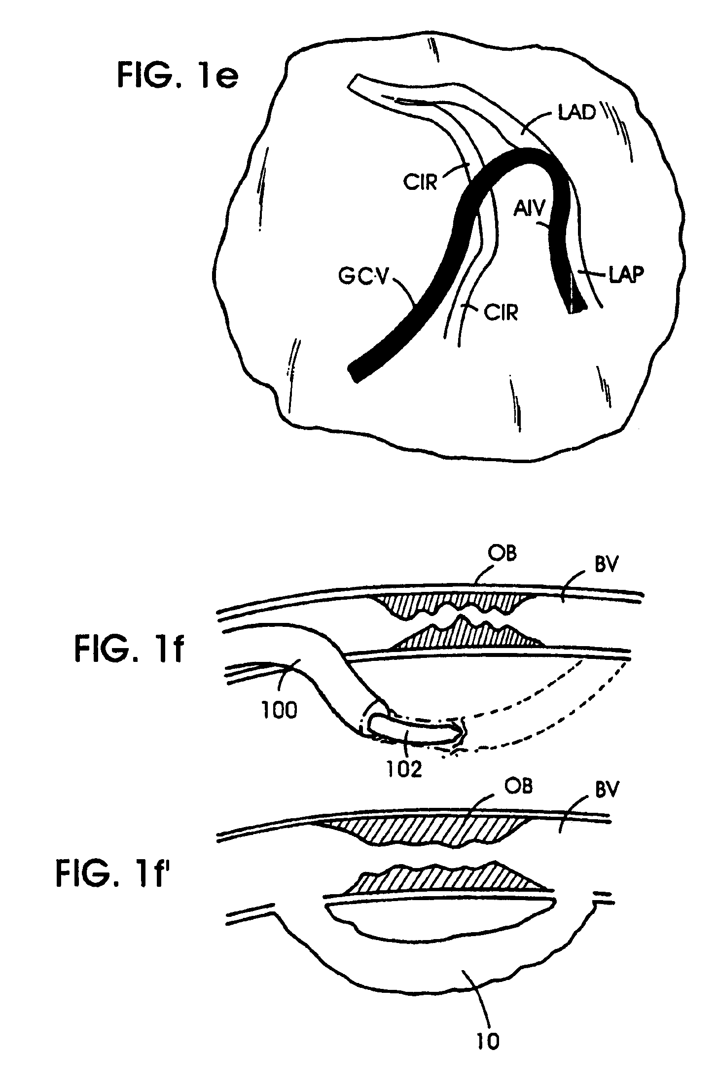 Methods and apparatus for bypassing arterial obstructions and/or performing other transvascular procedures