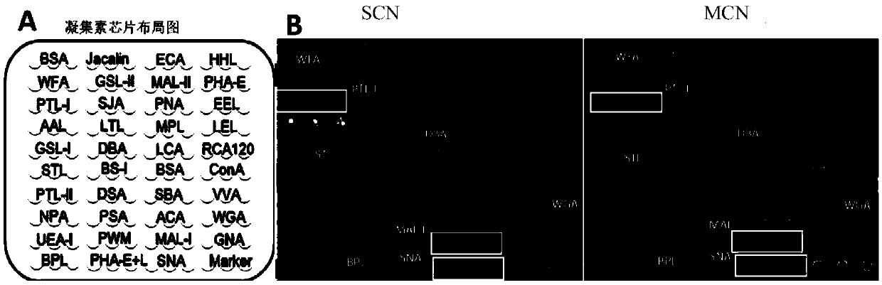 Application of sugar chains recognized by lectin group in differentiating pancreatic mucinous cystic neoplasms from pancreatic serous cystic neoplasms