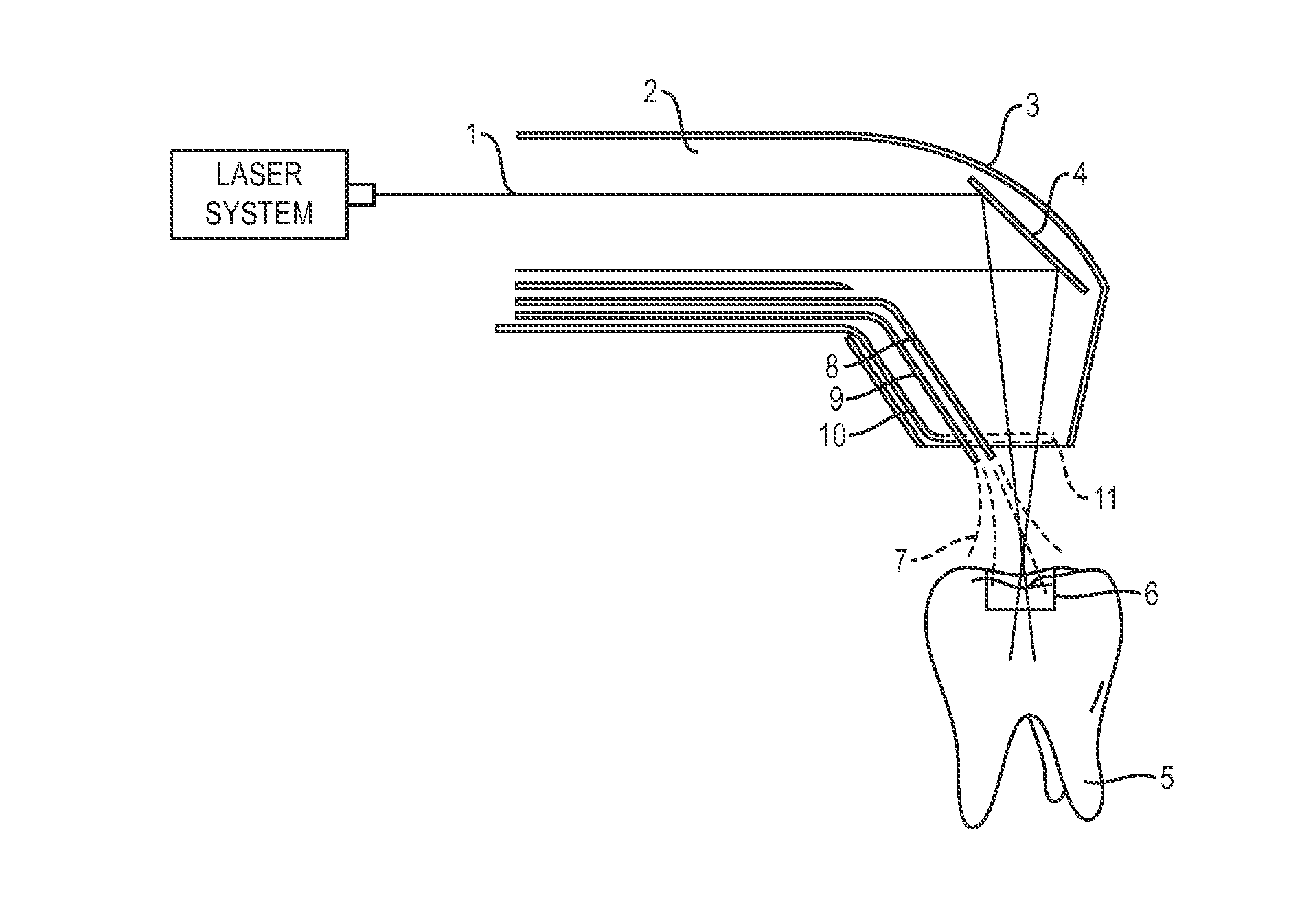 Apparatus and method for controlled fluid cooling during laser based dental treatments