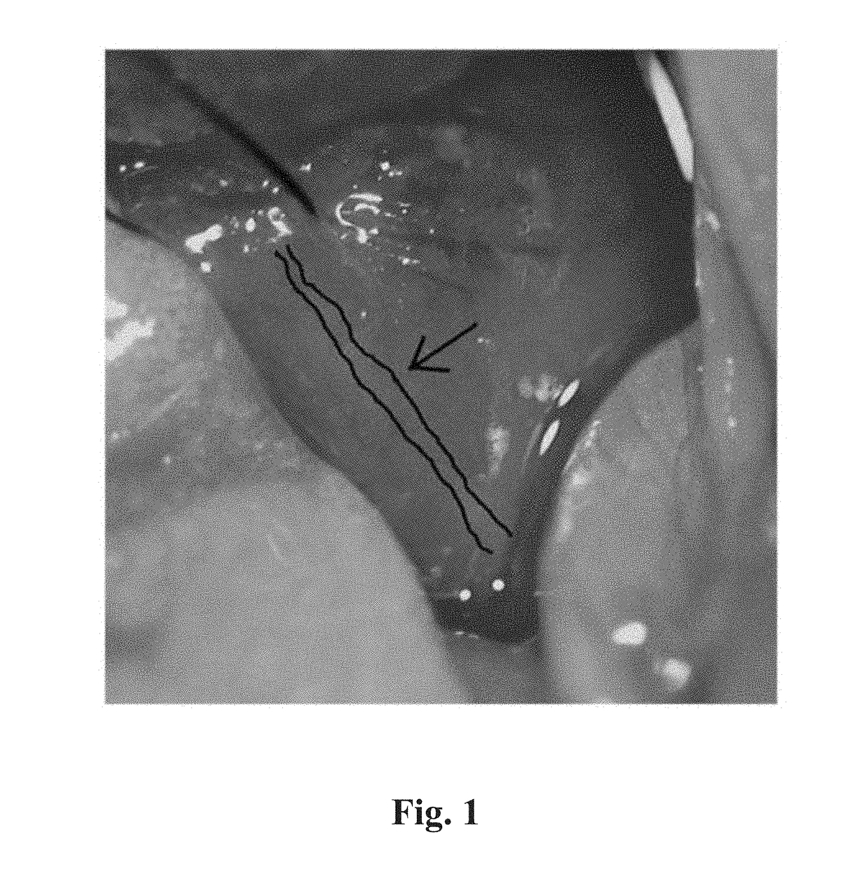 Method for preventing or treating heart failure