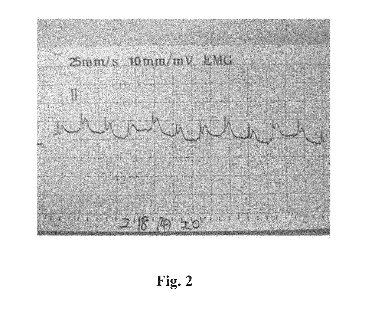 Method for preventing or treating heart failure
