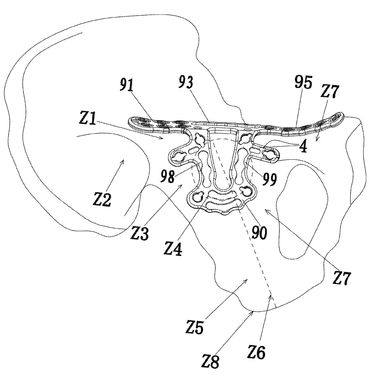 General anatomic self-locking plate for medial acetabulum and auxiliary apparatus thereof