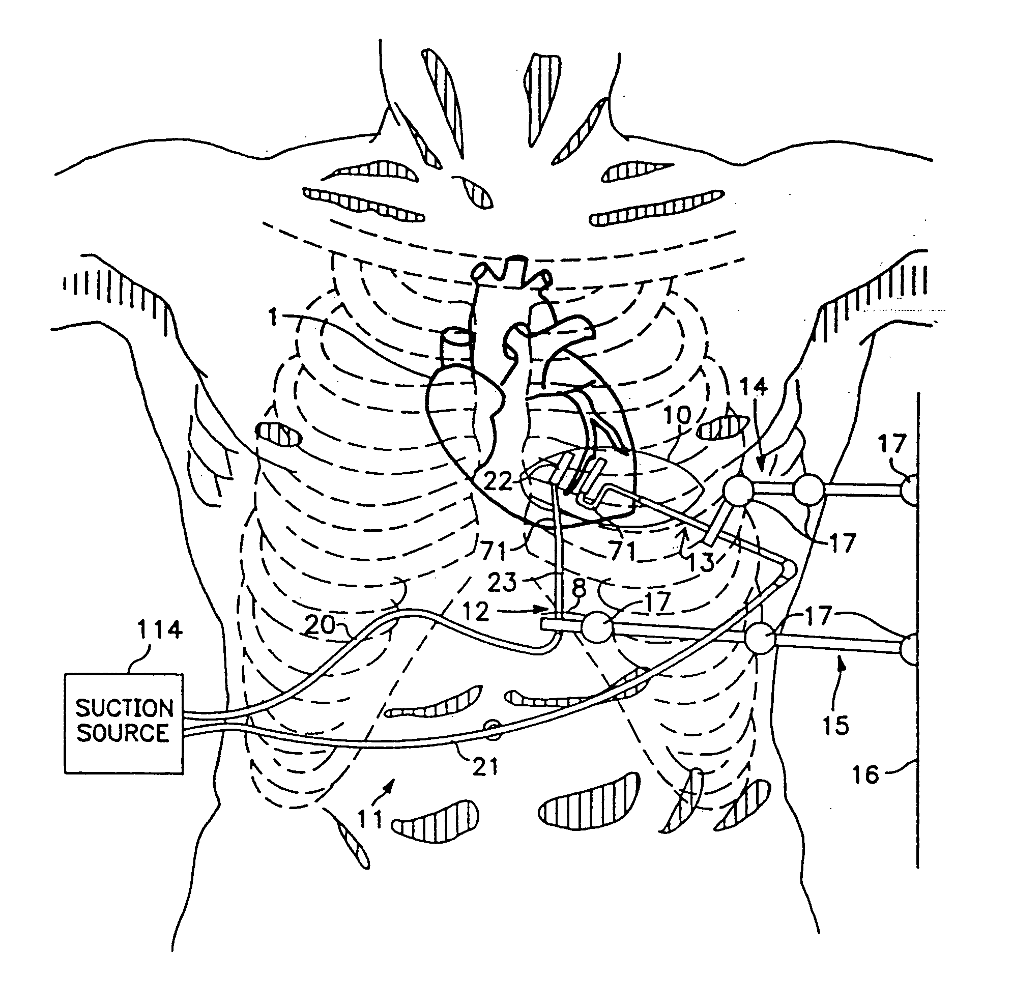 Method and apparatus for temporarily immobilizing a local area of tissue