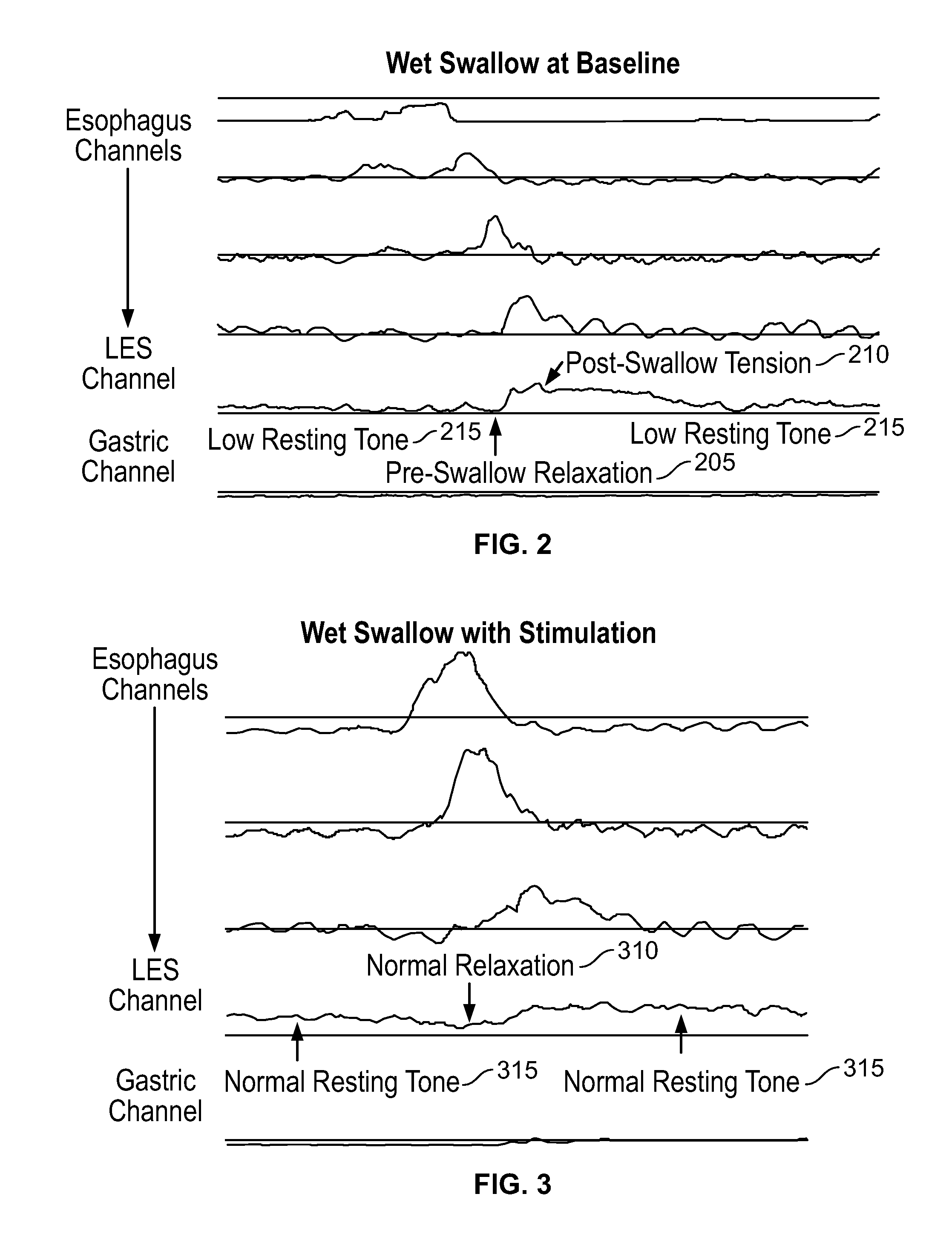 Device and Implantation System for Electrical Stimulation of Biological Systems