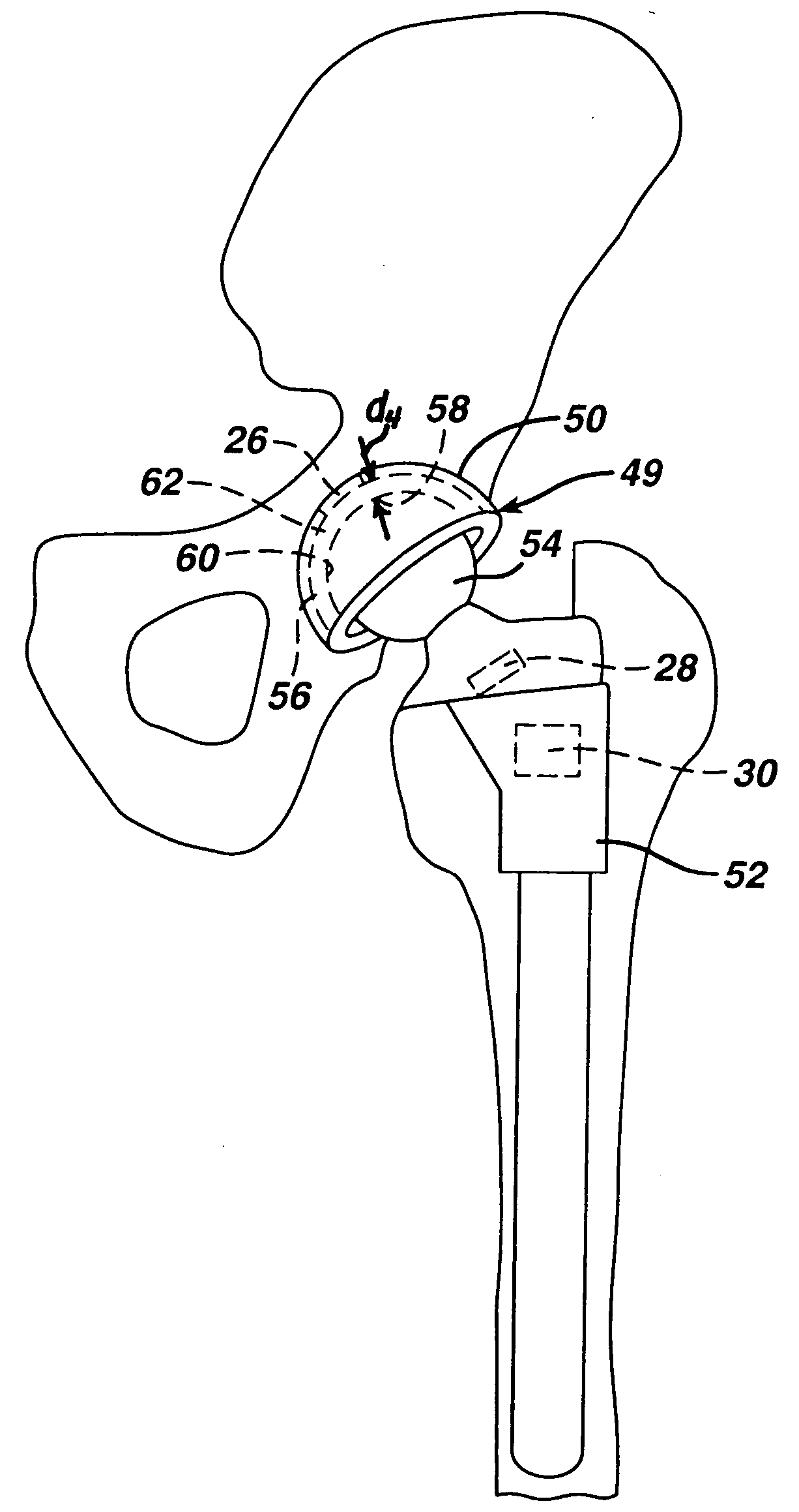 In vivo joint space measurement device and method