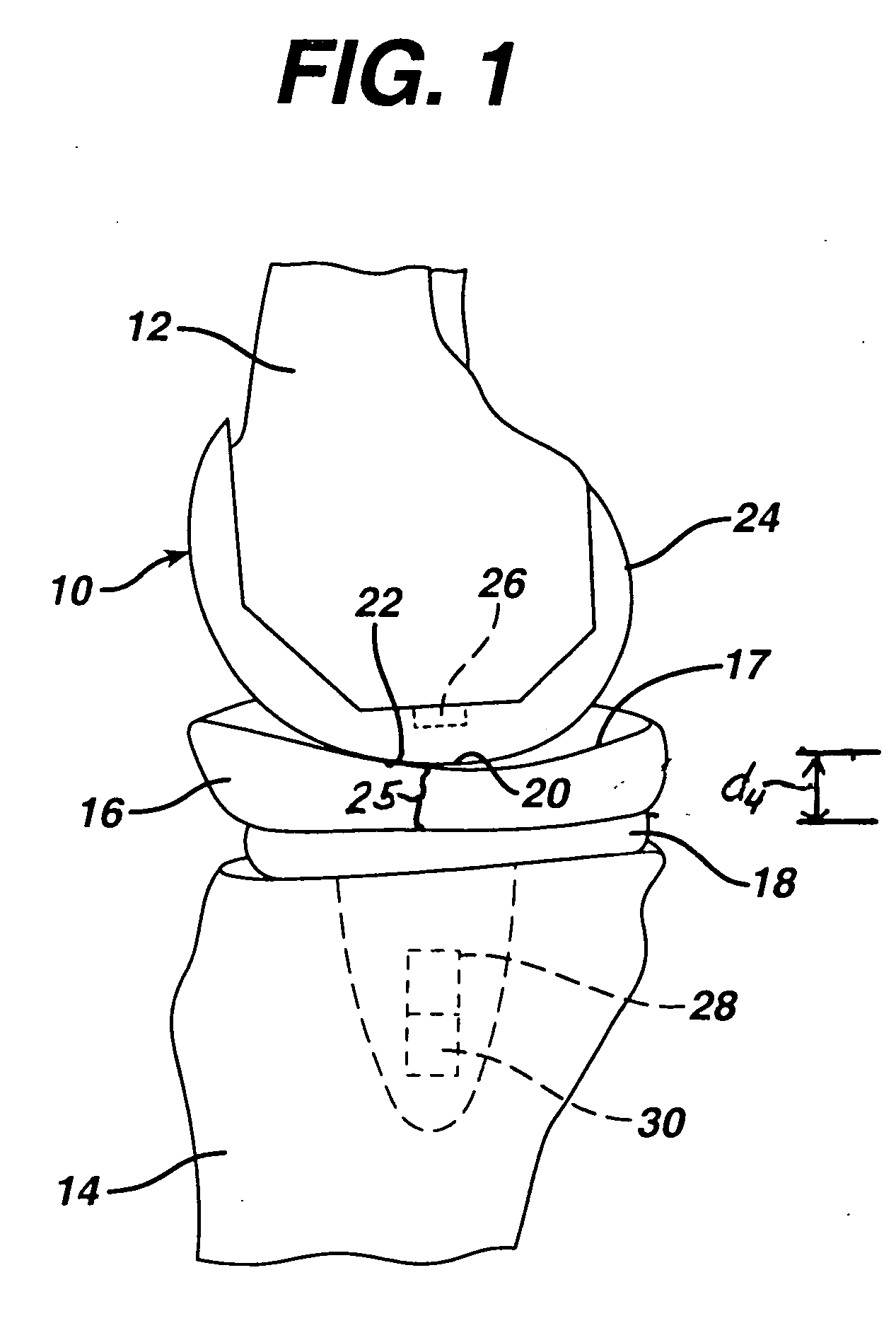 In vivo joint space measurement device and method
