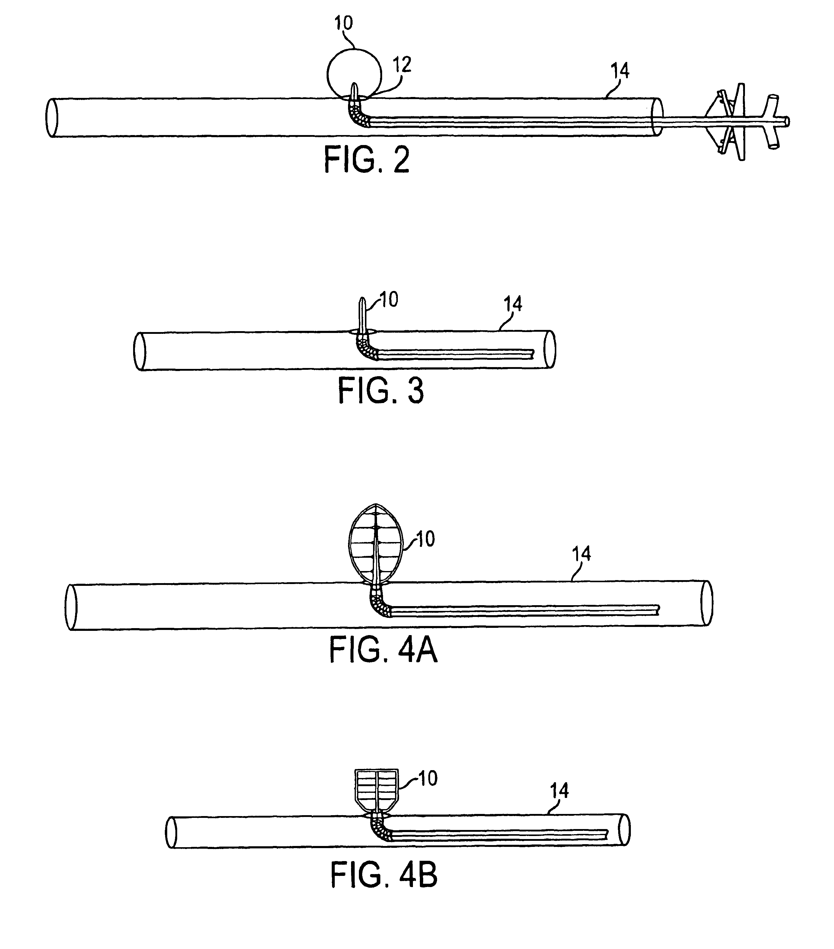Endovascular aneurysm treatment device and method