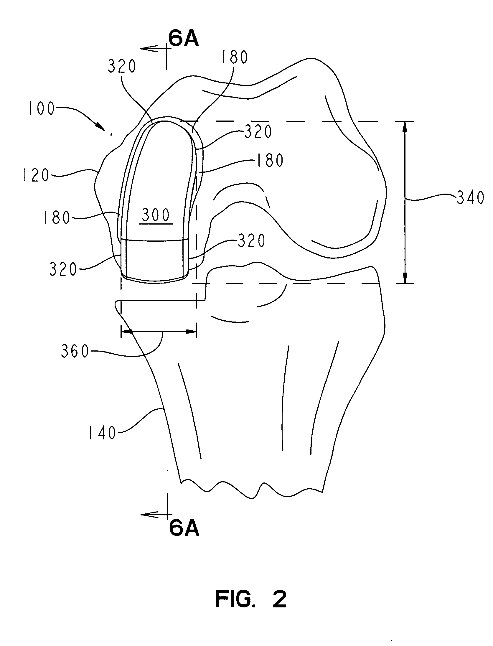 Femoral resection guide apparatus and method