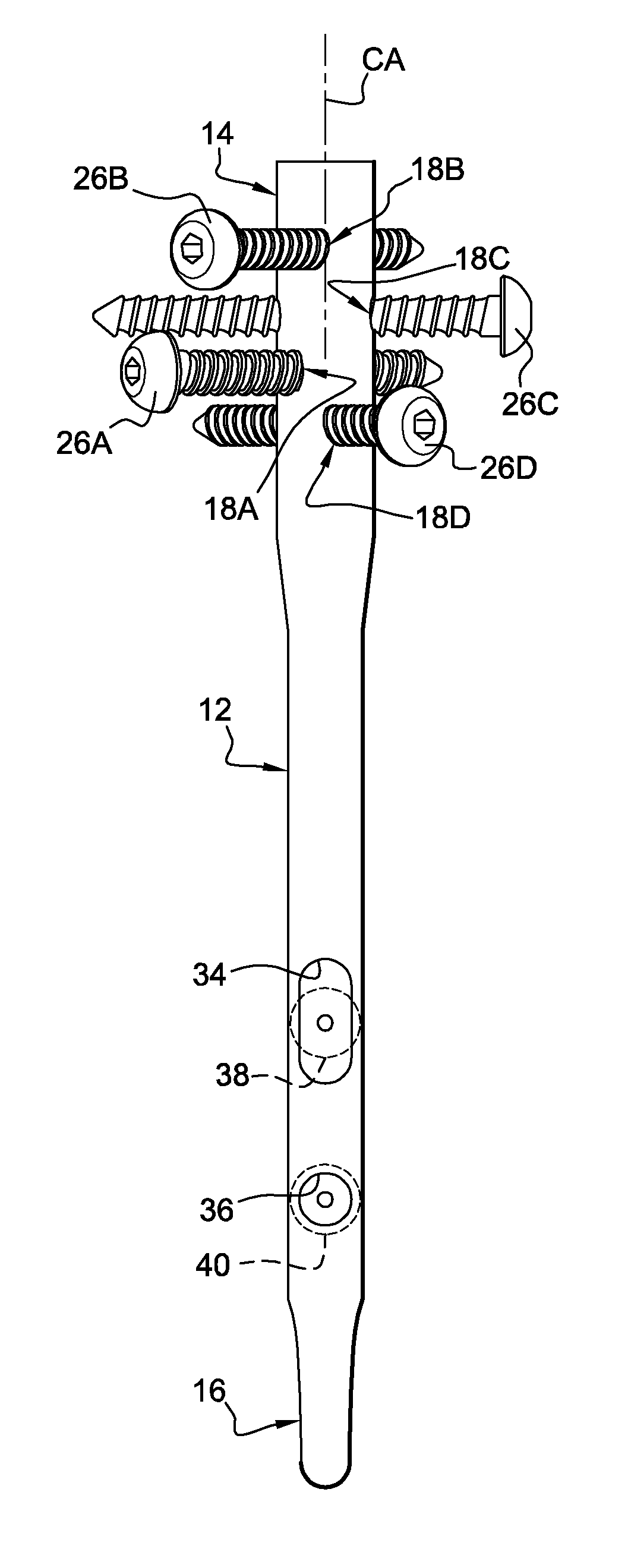 Surgical technique and apparatus for proximal humeral fracture repair