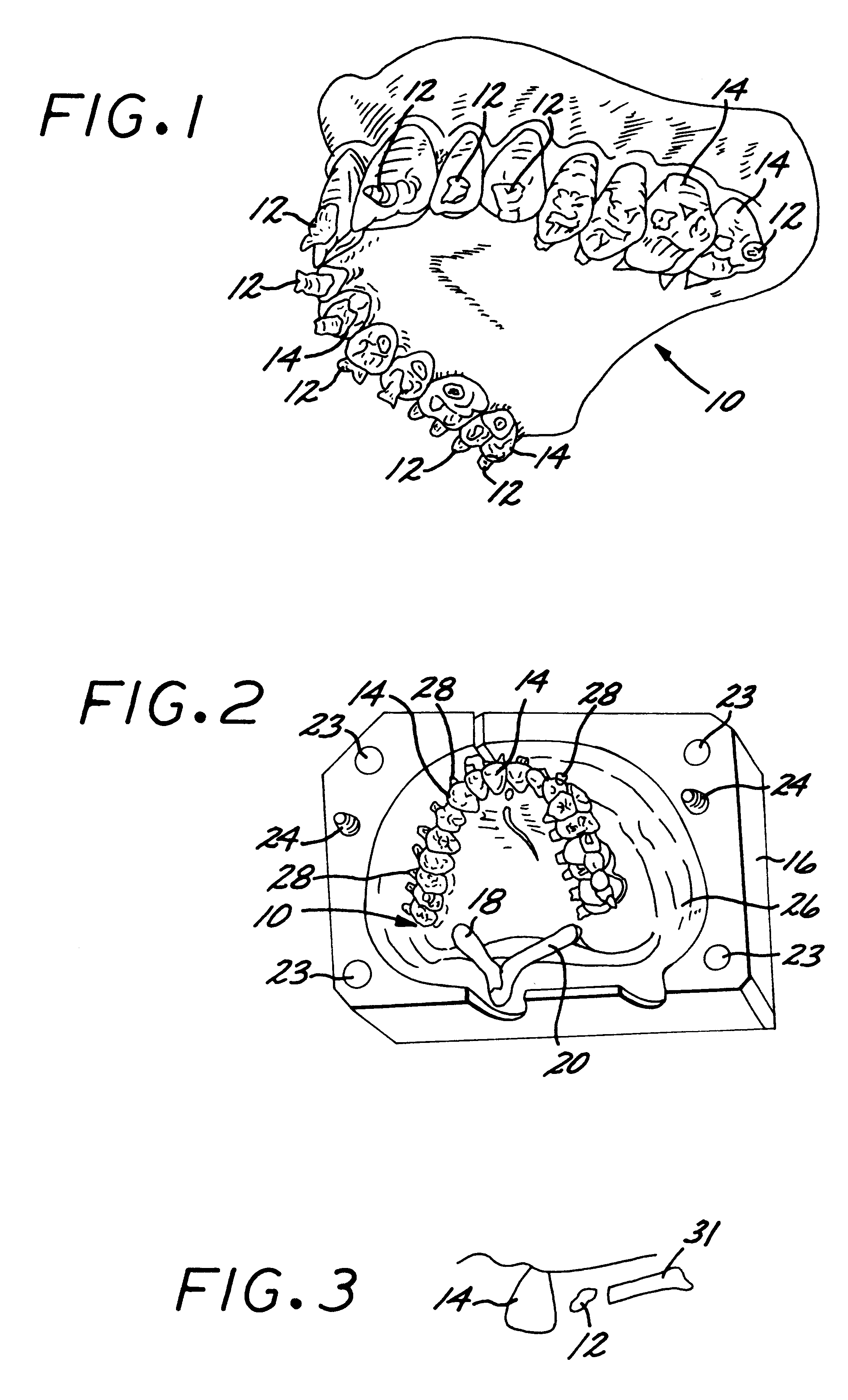 Method for fabricating removable denture prothesis using injection molding