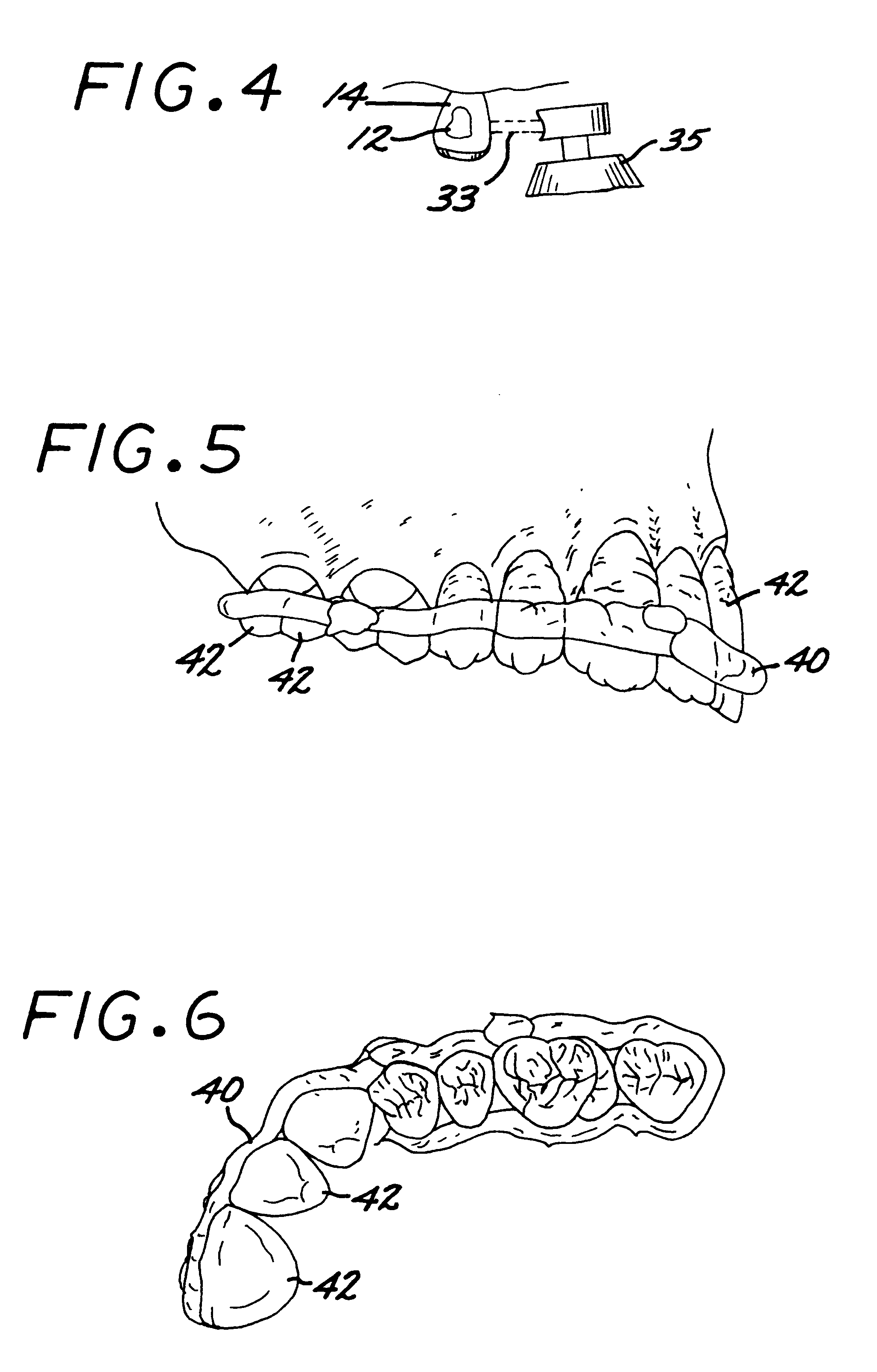 Method for fabricating removable denture prothesis using injection molding