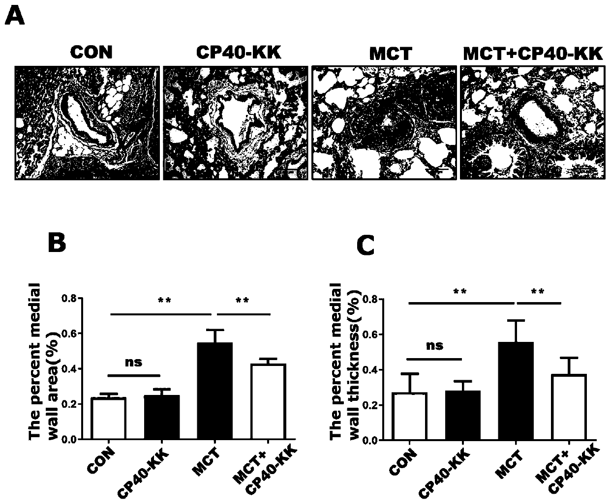 Application of complement C3 inhibitor CP40-KK in preparation of medicine for preventing and treating pulmonary arterial hypertension