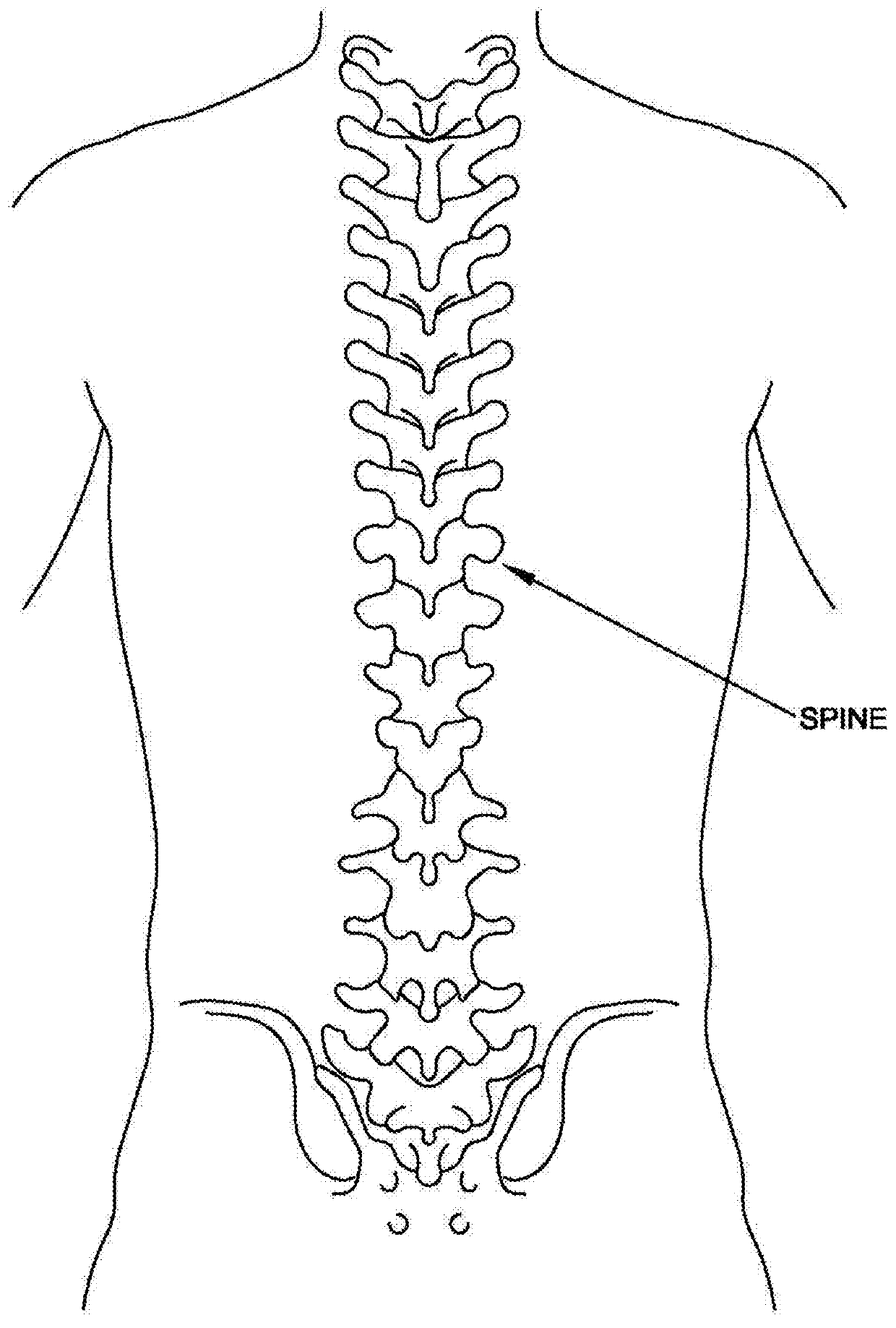 Sublaminar spinal fixation system and method of use