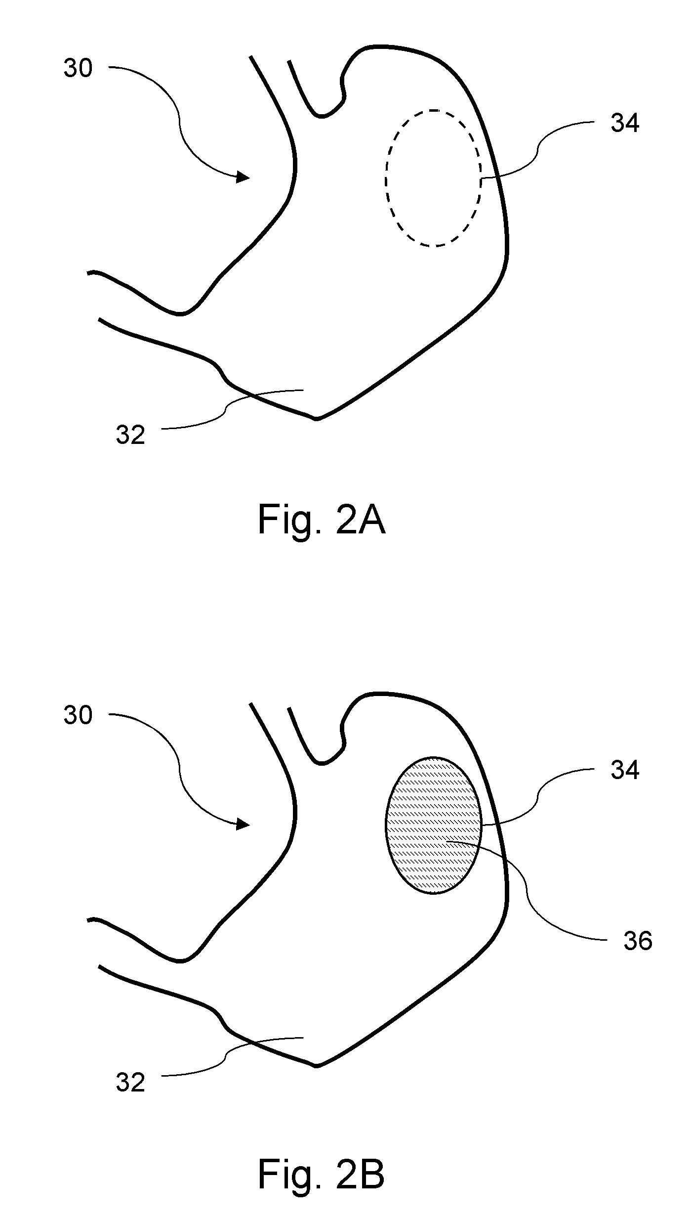 Nanotracer for in-situ gastric cancer detection