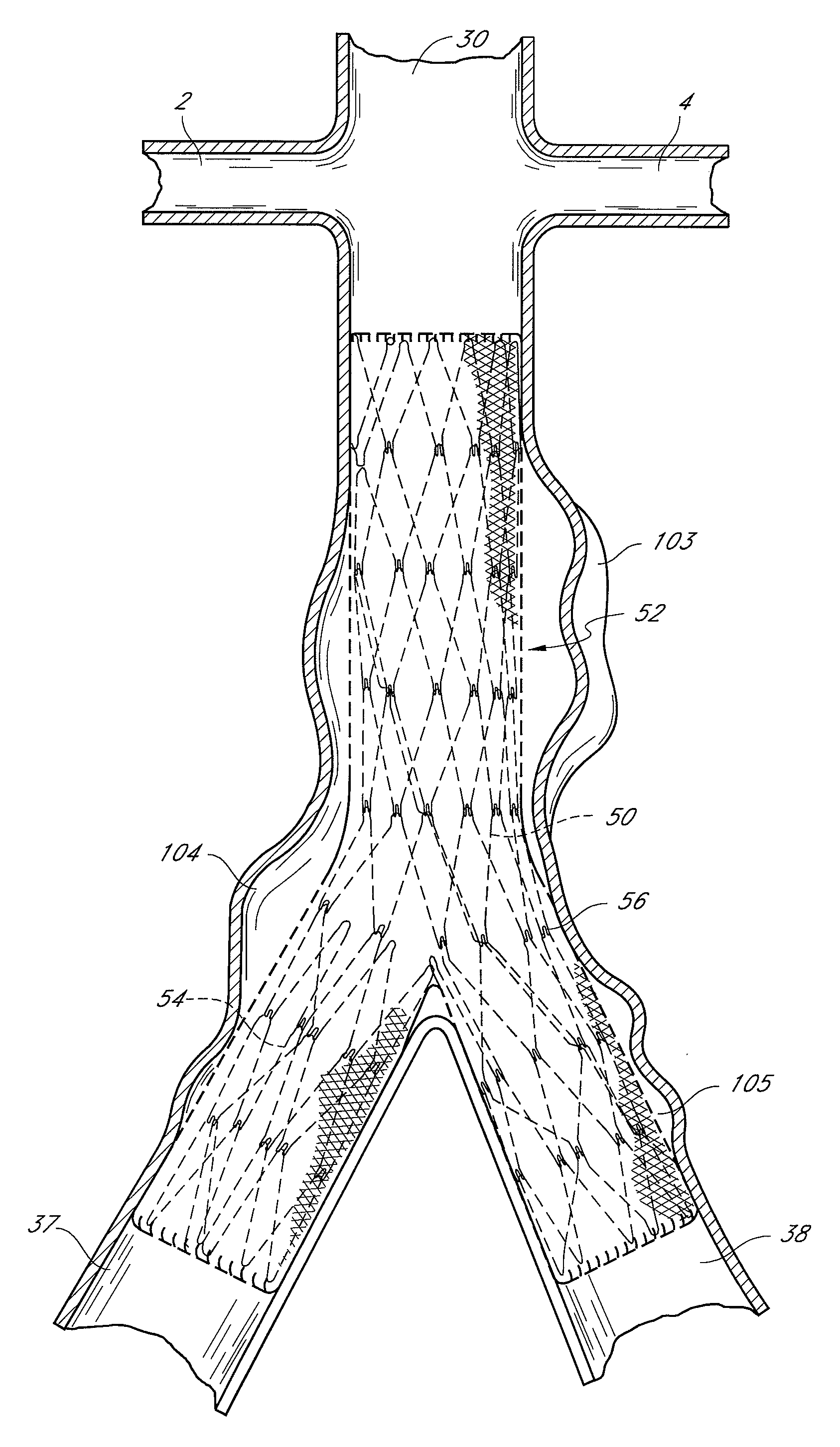 Dual concentric guidewire and methods of bifurcated graft deployment
