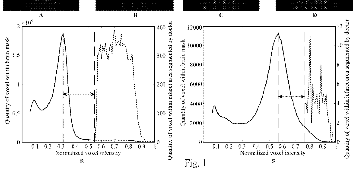 Method for detecting and quantifying cerebral infarct