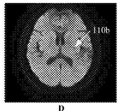 Method for detecting and quantifying cerebral infarct
