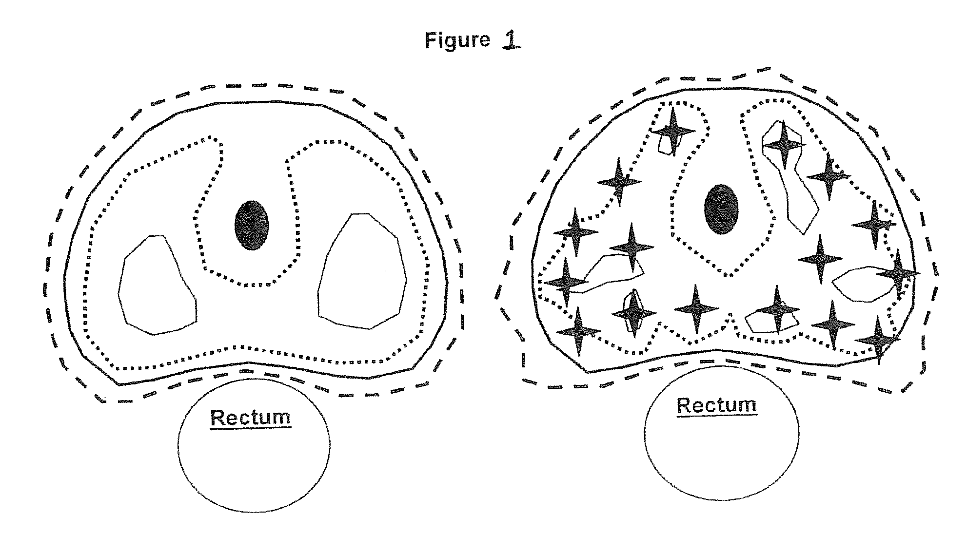 Methods for performing radiosurgery using non-homogeneous stereotactic techniques