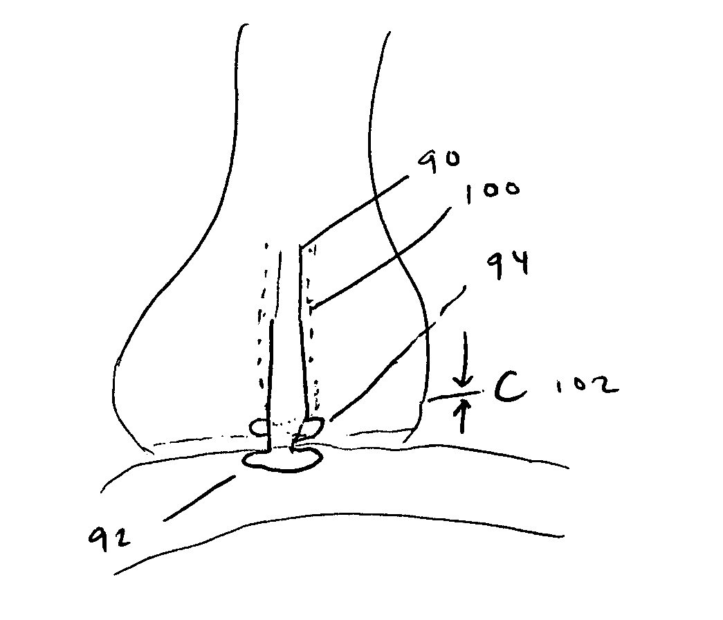 Methods and devices to facilitate connections between body lumens