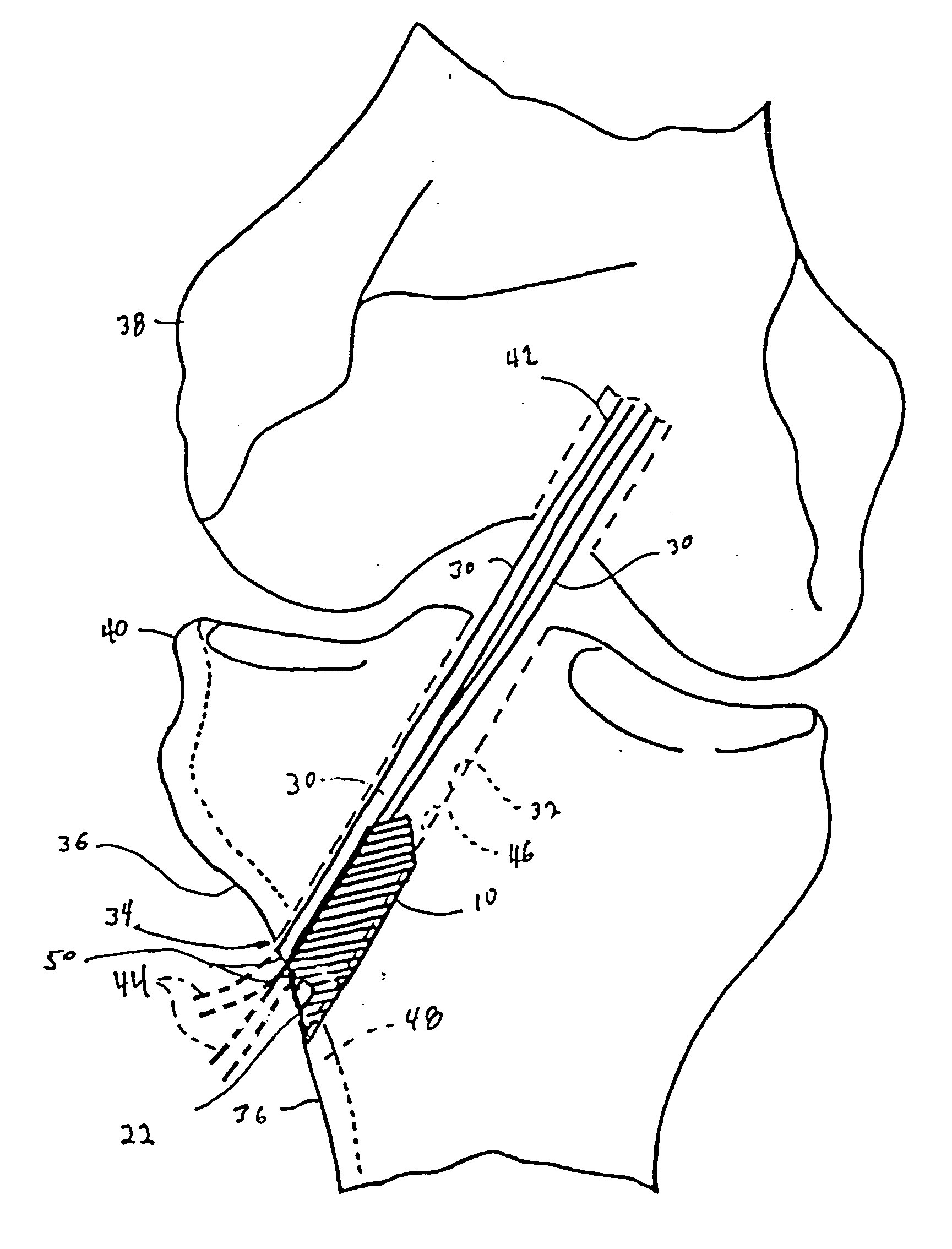 Fixation screw, graft ligament anchor assembly, and method for securing a graft ligament in a bone tunnel