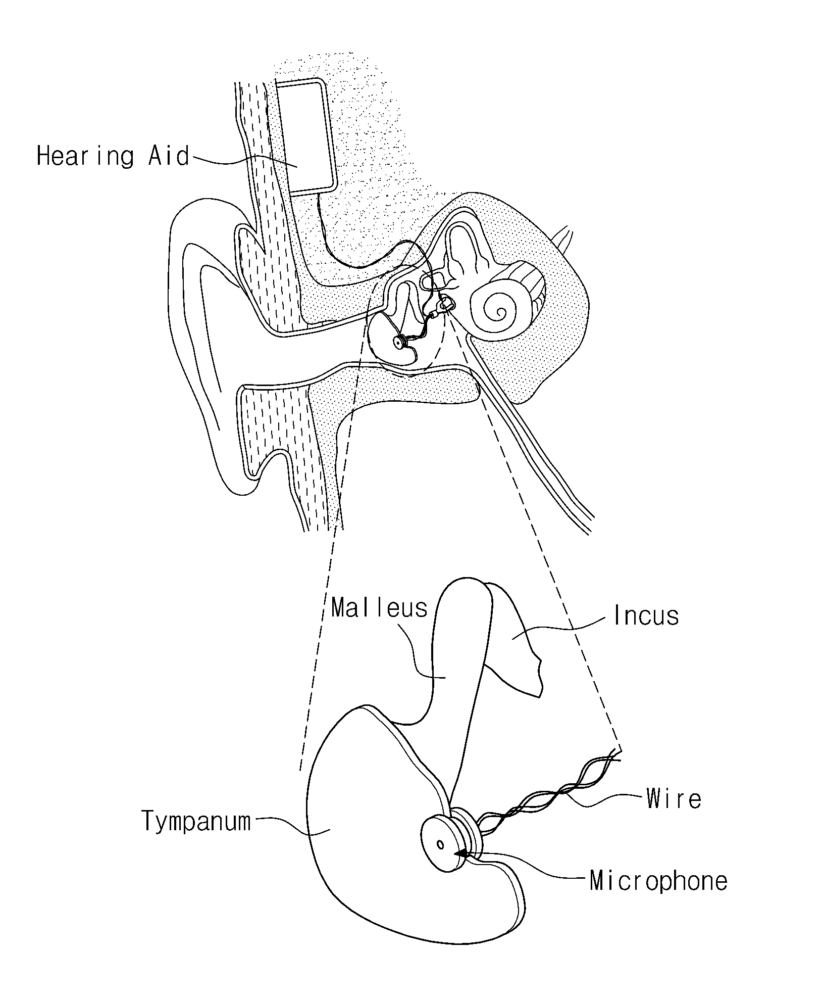 Easily installable microphone for implantable hearing aid