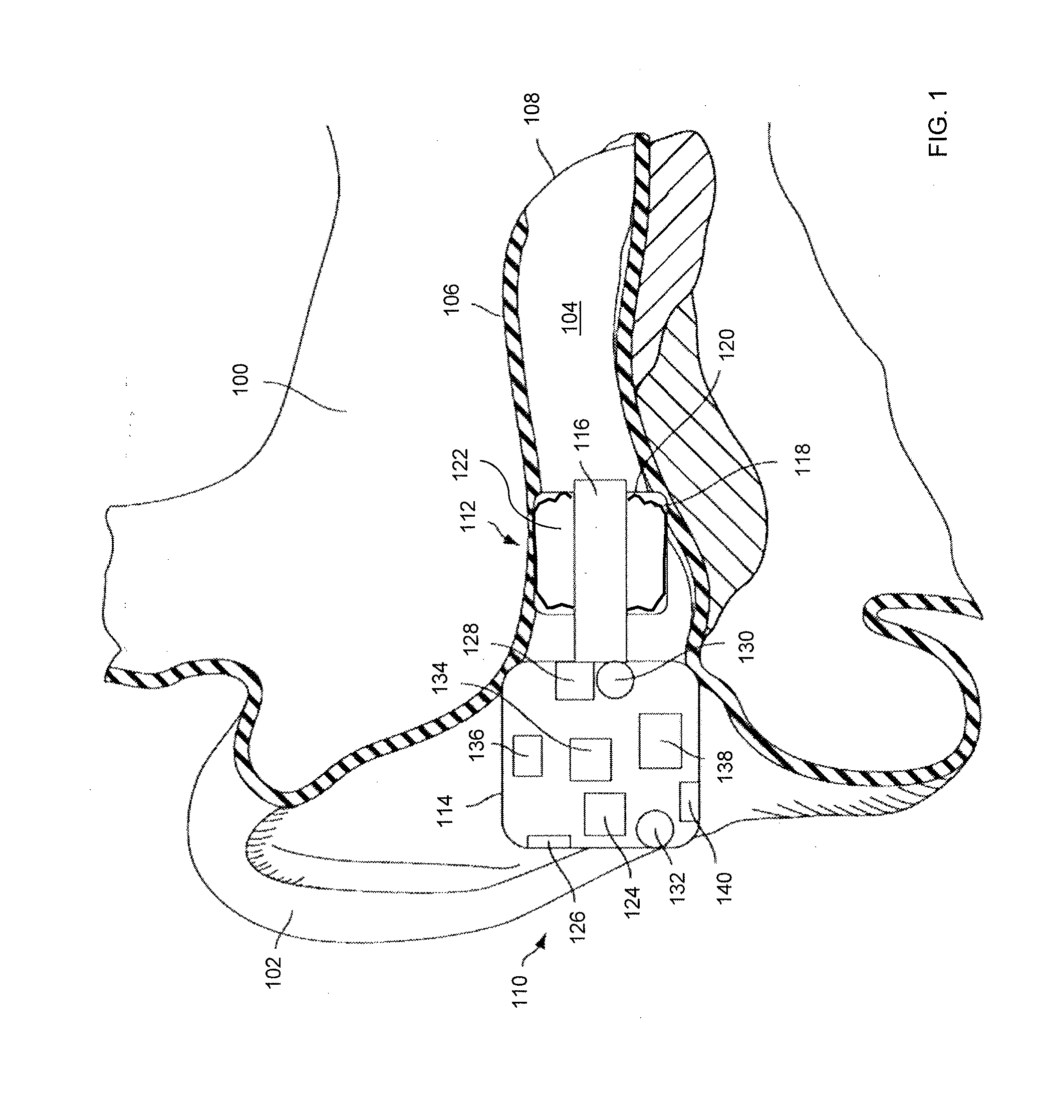 Occlusion device capable of occluding an ear canal