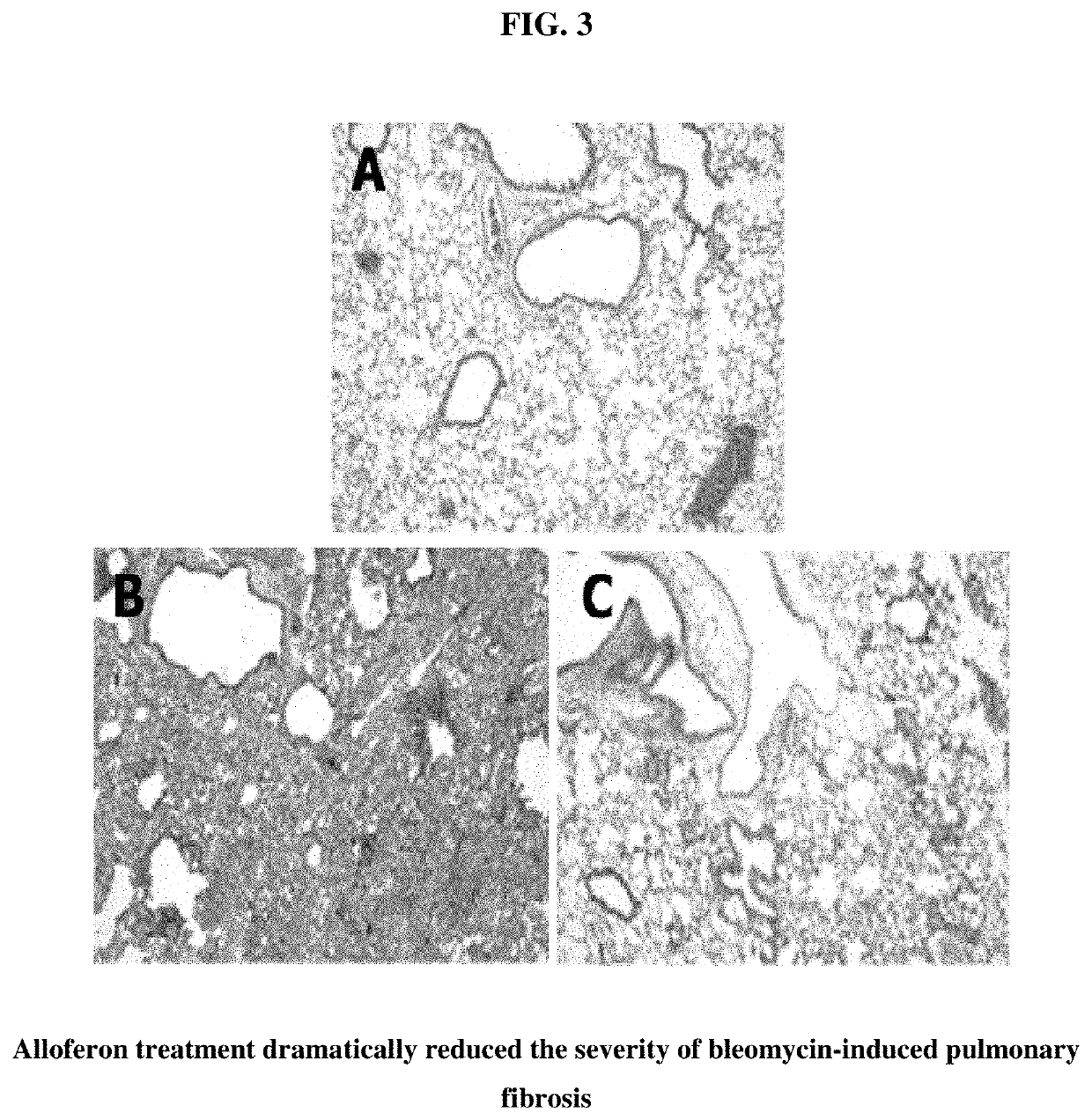 Composition for treating pulmonary fibrosis comprising alloferon