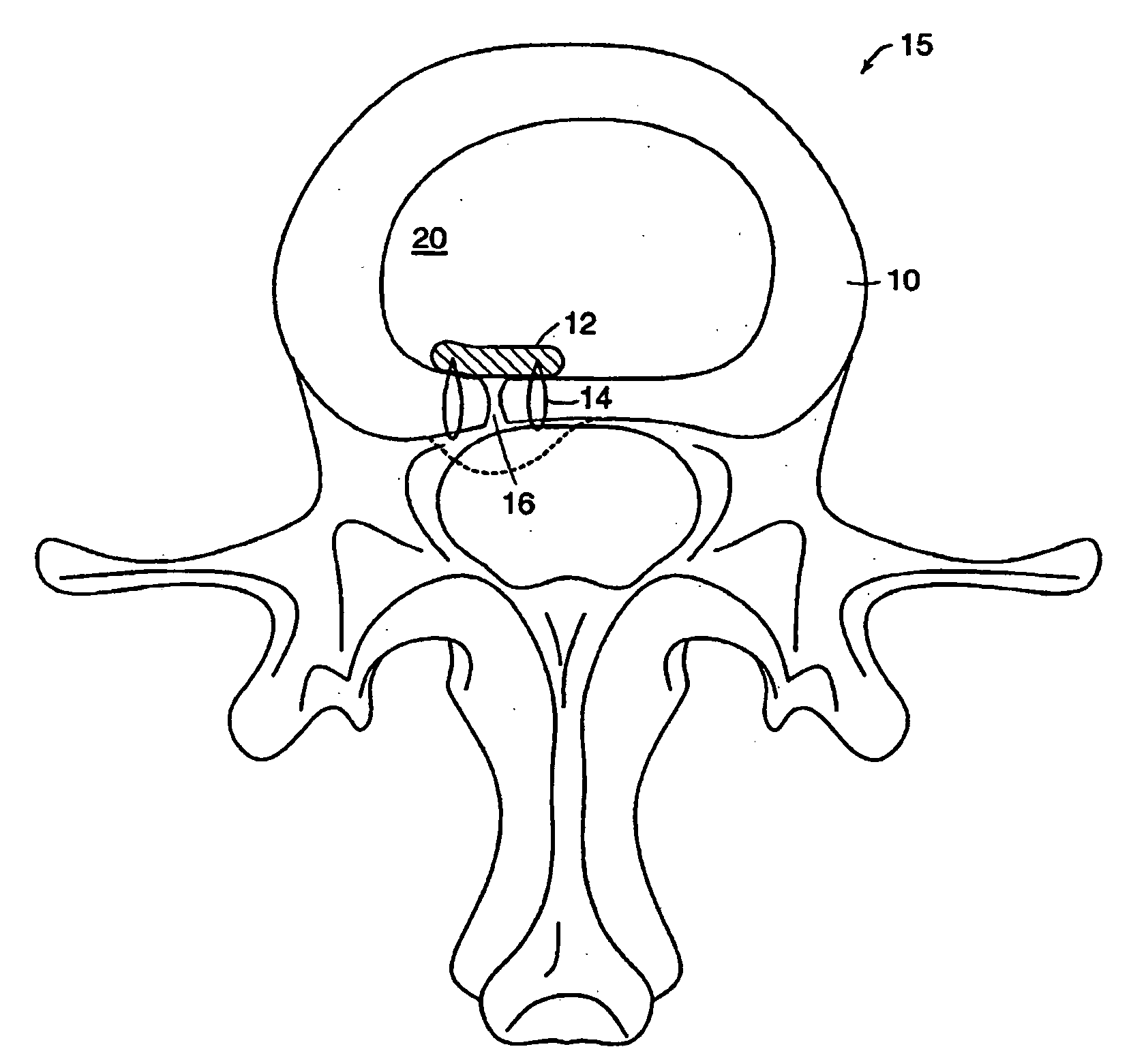 Method of reducing spinal implant migration
