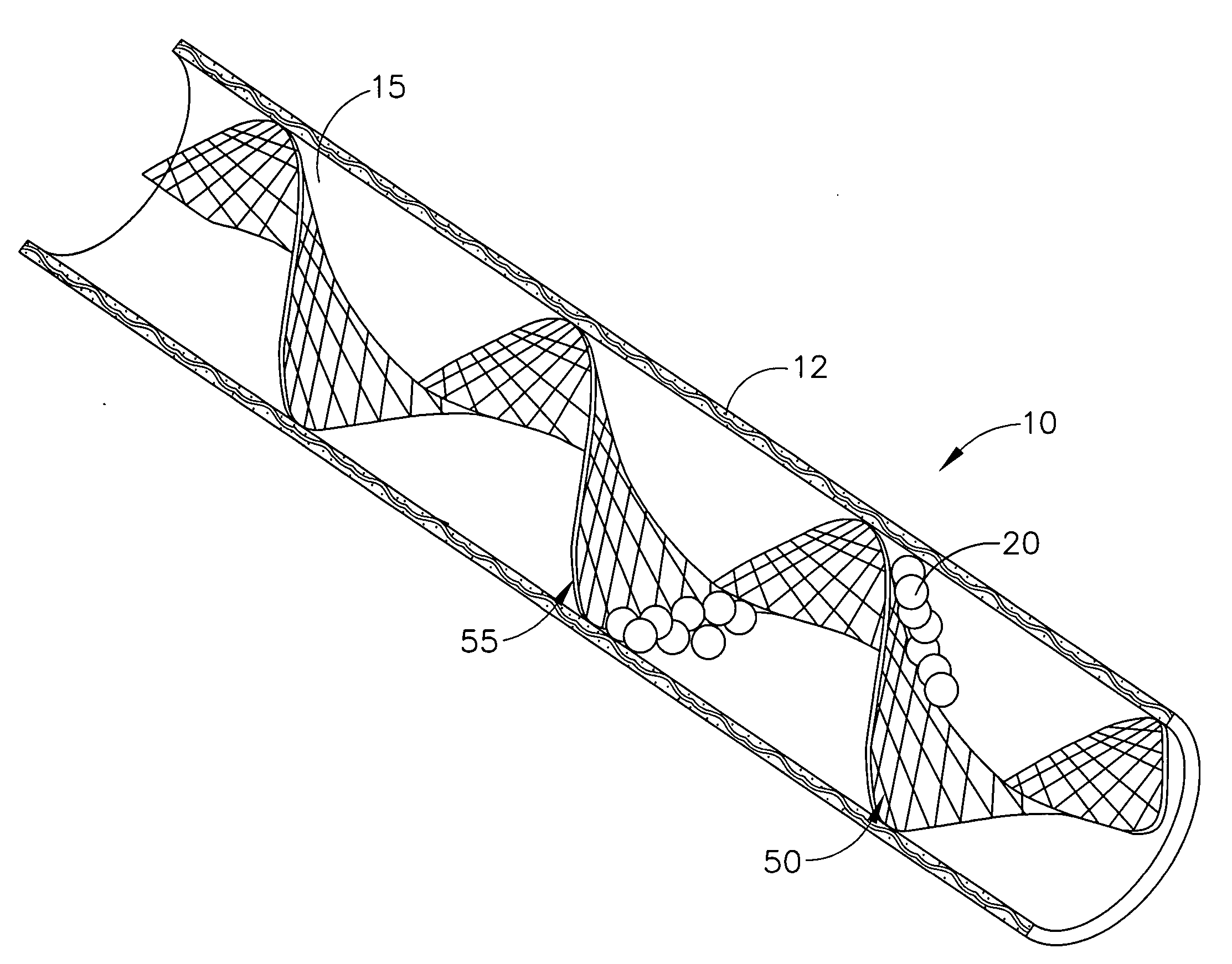 Method for filtering blood in a vessel with helical elements