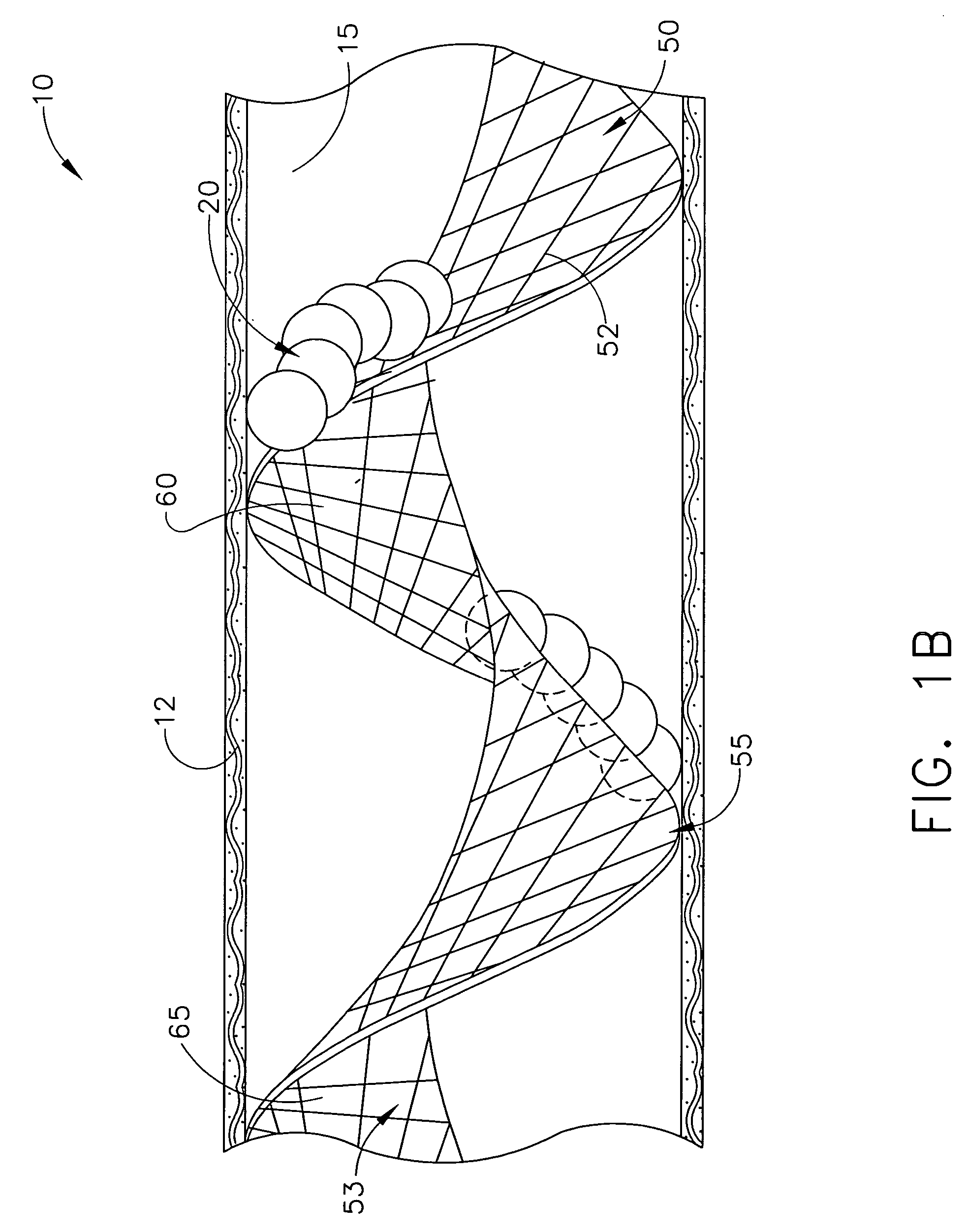 Method for filtering blood in a vessel with helical elements