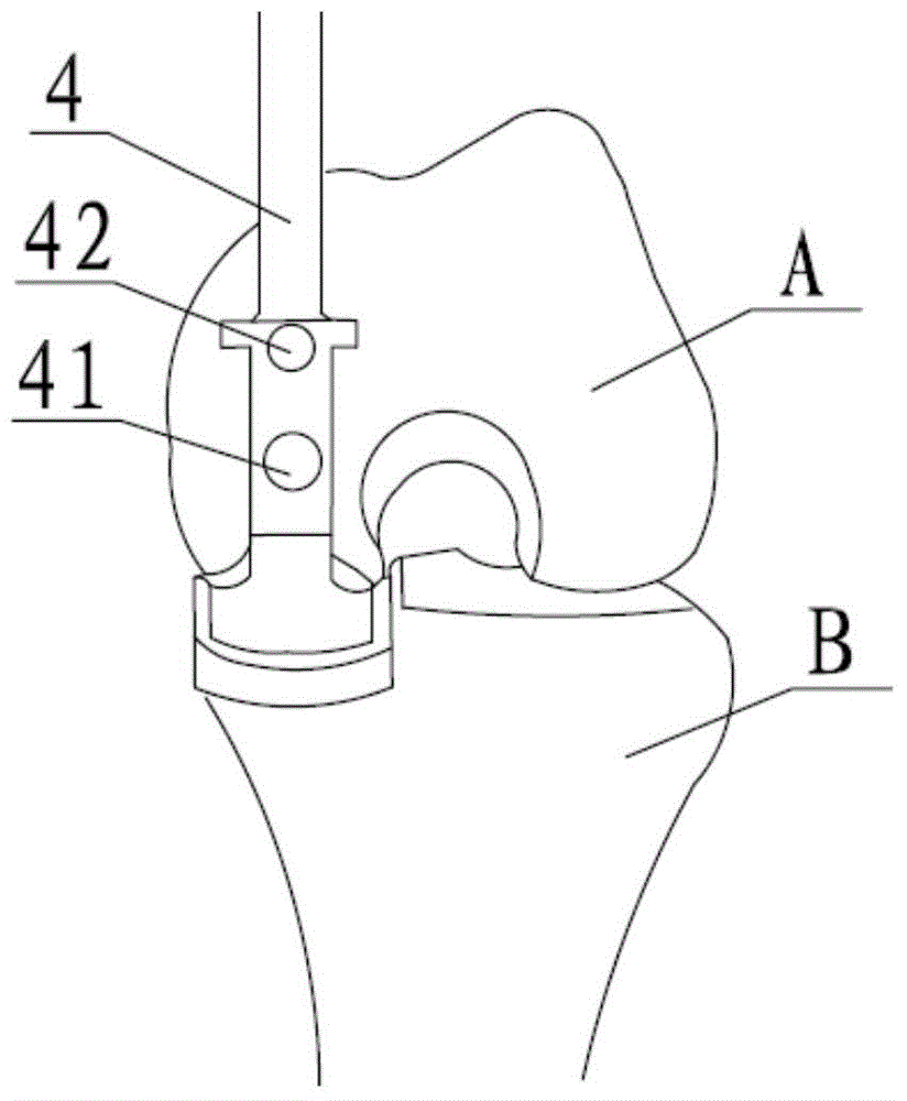 Femoral condyle gauge for unicompartmental arthroplasty